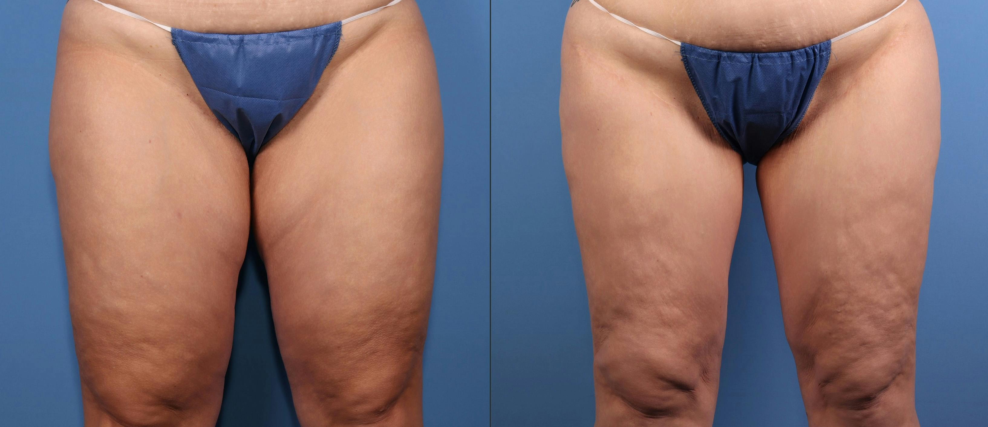 Thigh Lift Before & After Gallery - Patient 175636 - Image 1