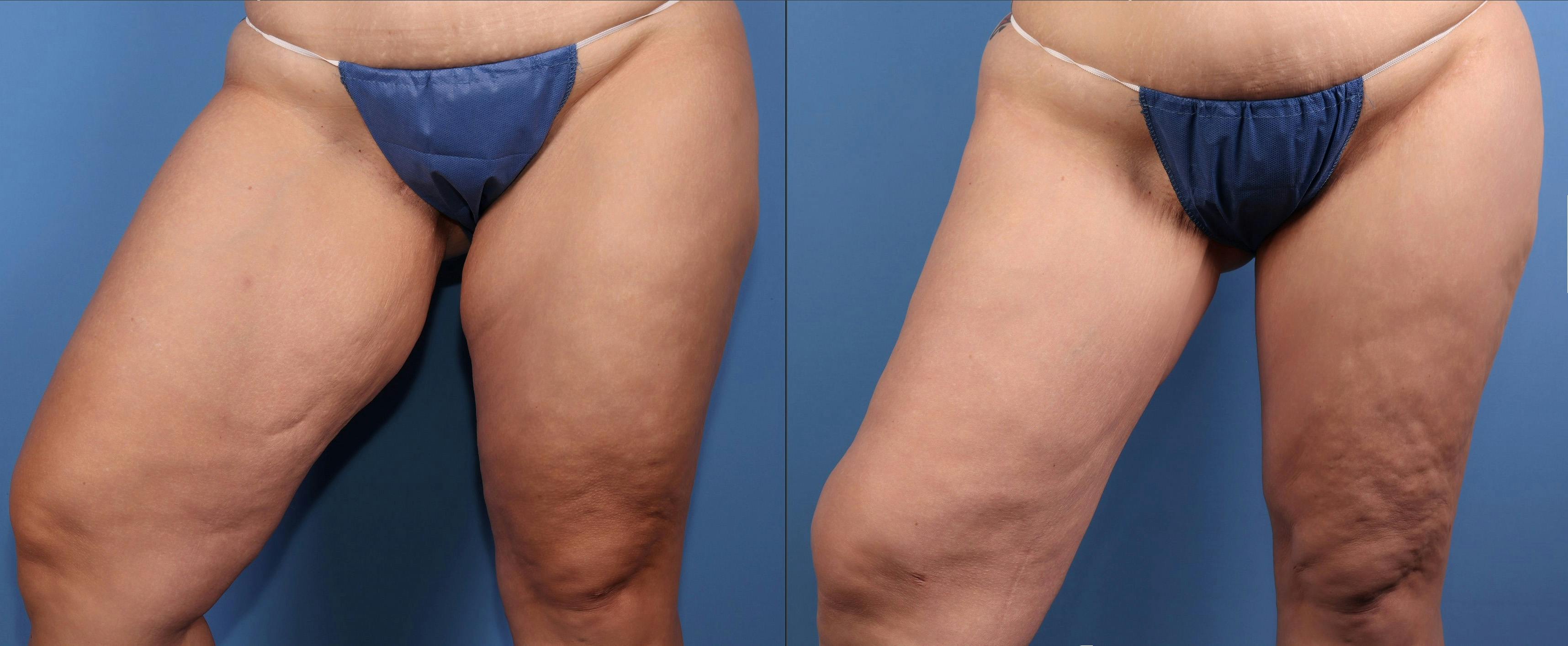 Thigh Lift Before & After Gallery - Patient 175636 - Image 2