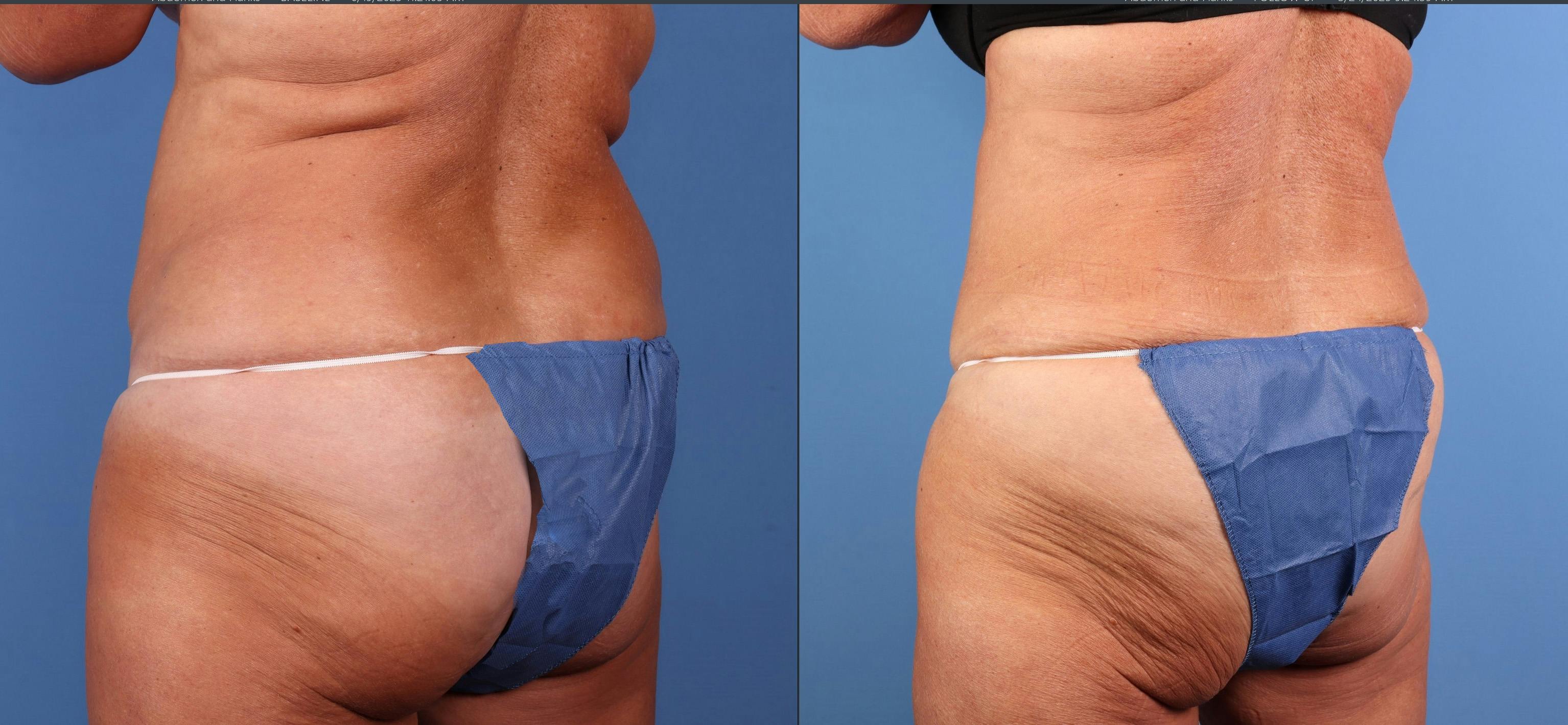 Tummy Tuck Before & After Gallery - Patient 676805 - Image 4