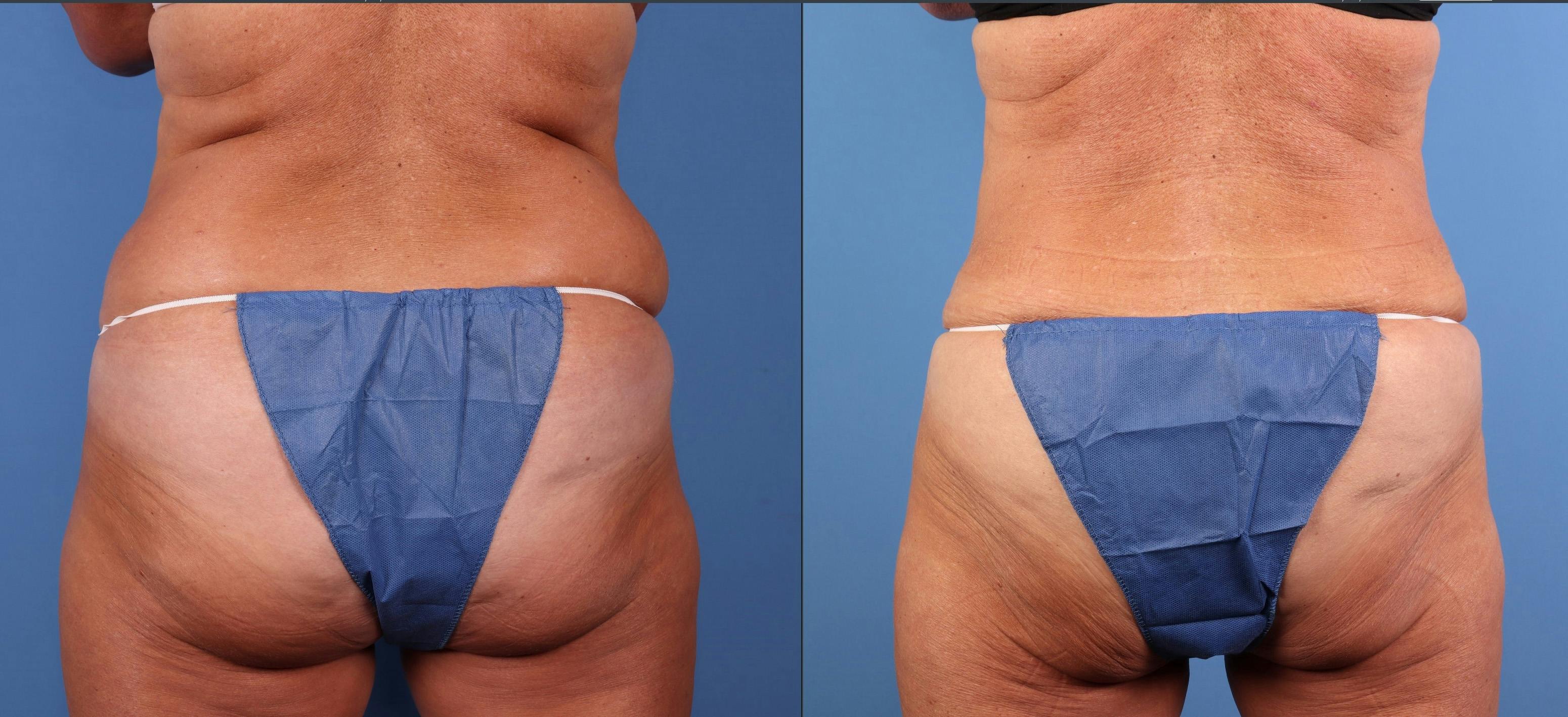 Tummy Tuck Before & After Gallery - Patient 676805 - Image 5