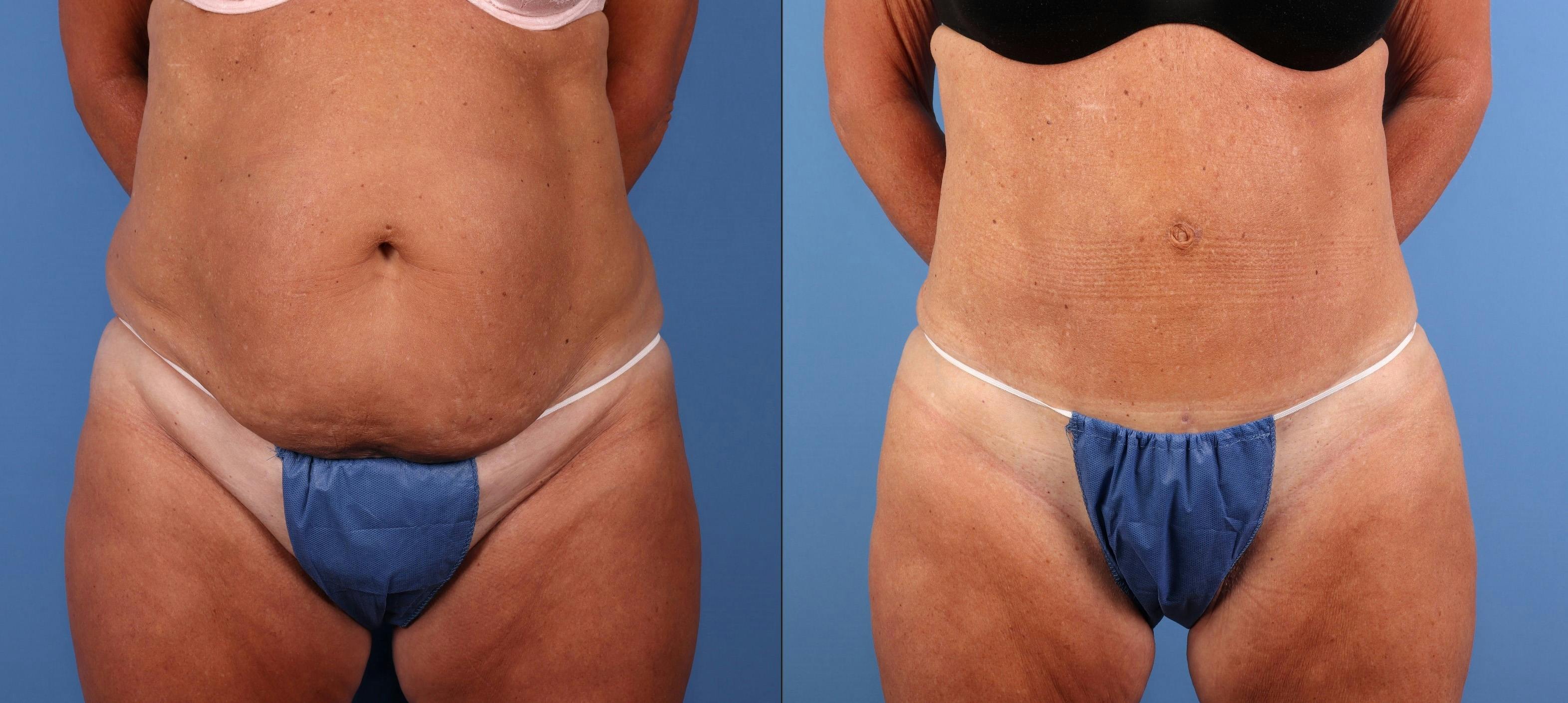 Tummy Tuck Before & After Gallery - Patient 676805 - Image 1