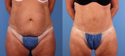 Tummy Tuck Before & After Gallery - Patient 676805 - Image 1
