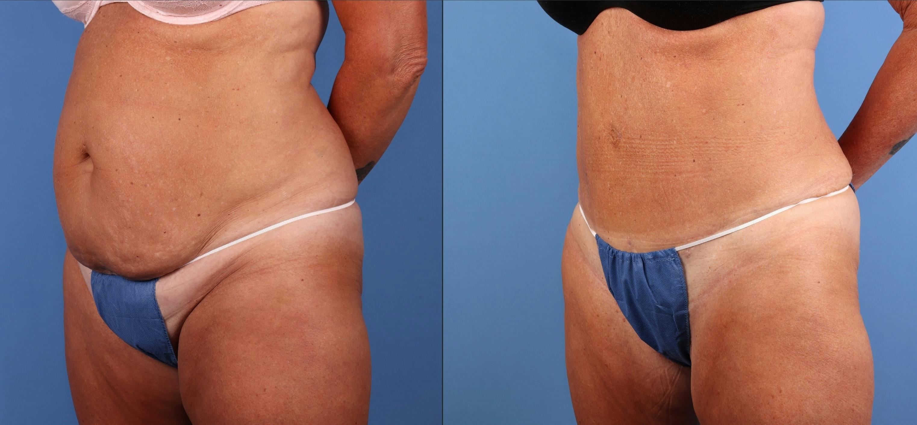 Tummy Tuck Before & After Gallery - Patient 676805 - Image 2
