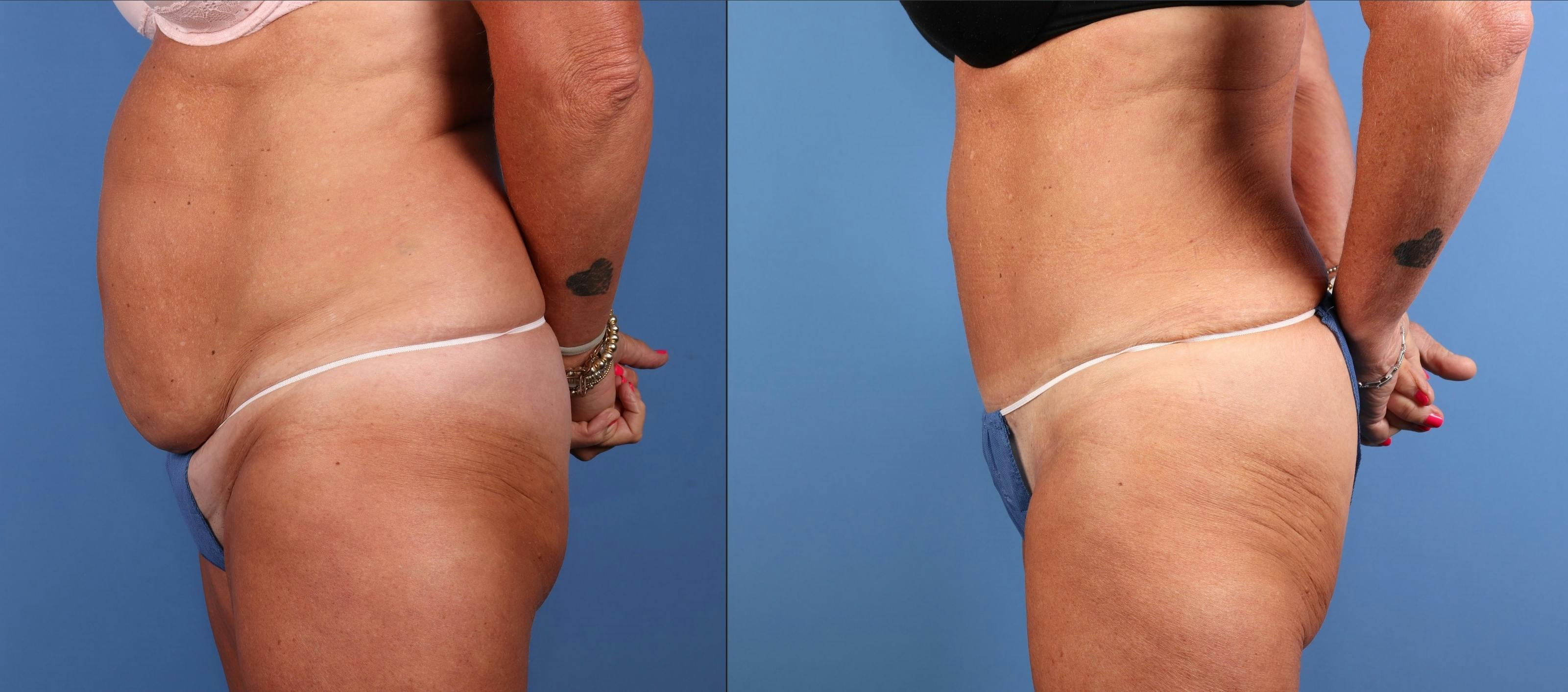 Tummy Tuck Before & After Gallery - Patient 676805 - Image 3