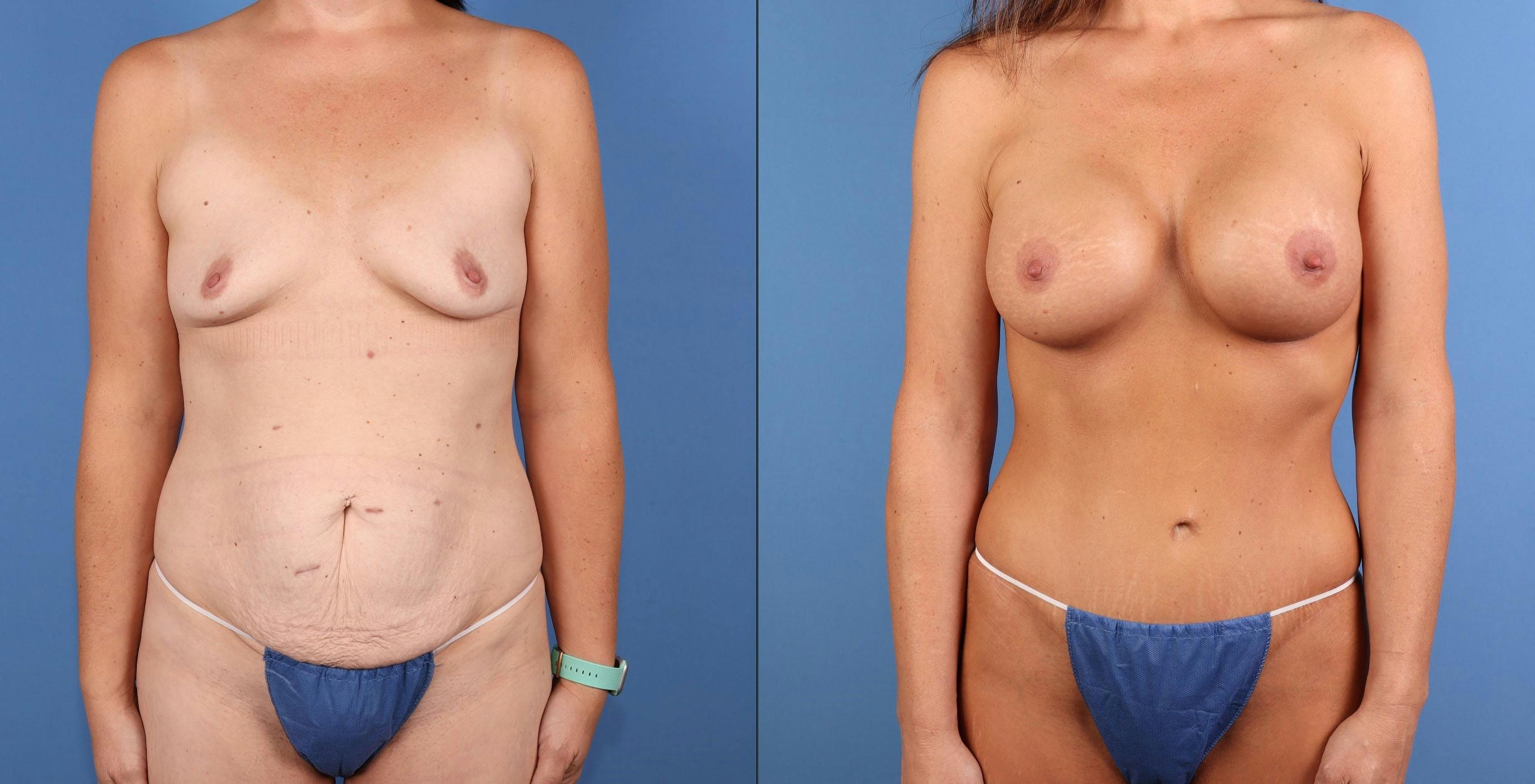 Mommy Makeover Before & After Gallery - Patient 142767 - Image 1