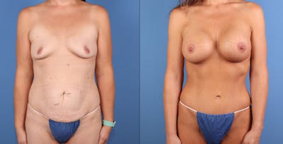 Mommy Makeover Before & After Gallery - Patient 142767 - Image 1