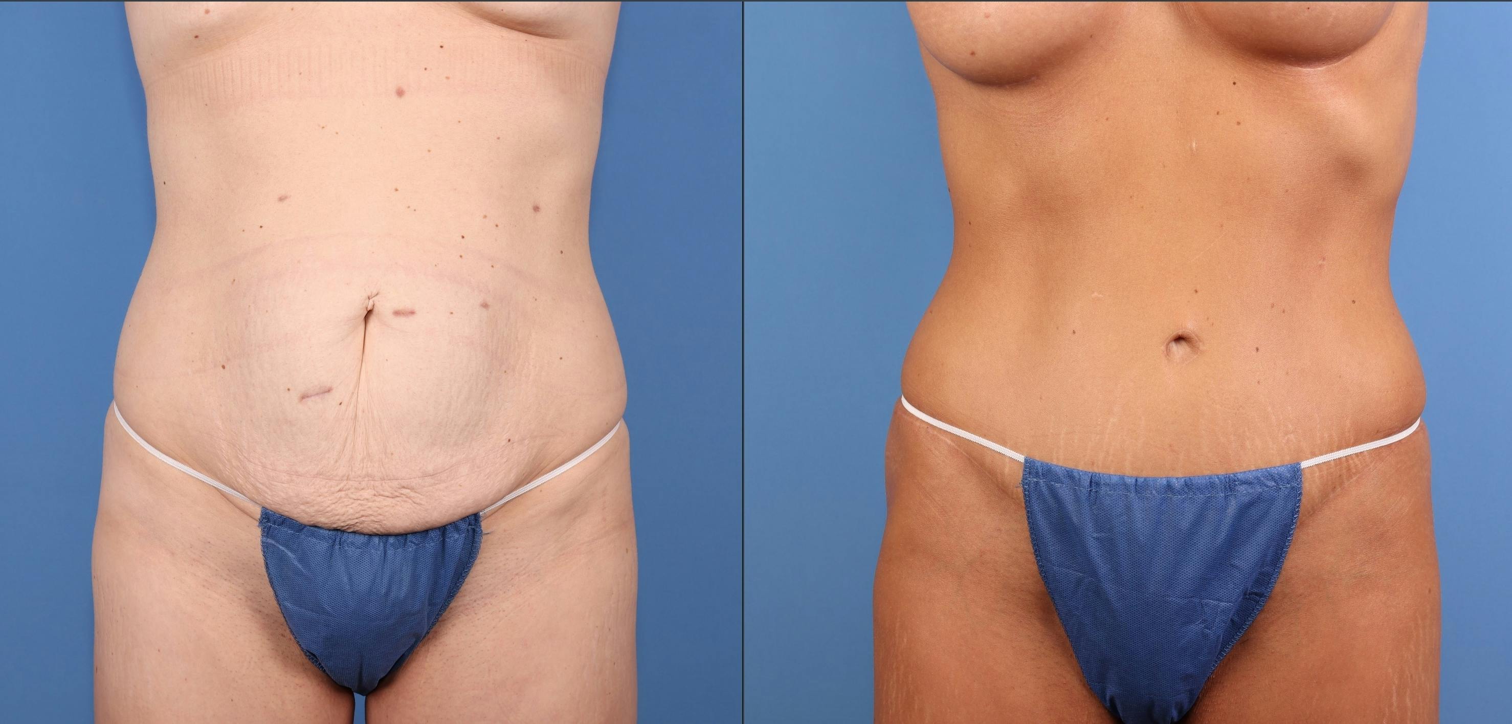 Tummy Tuck Before & After Gallery - Patient 211416 - Image 1