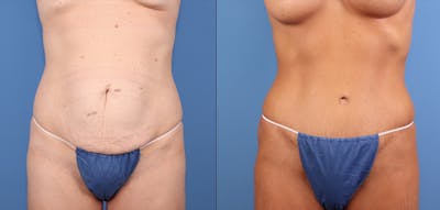 Tummy Tuck Before & After Gallery - Patient 211416 - Image 1