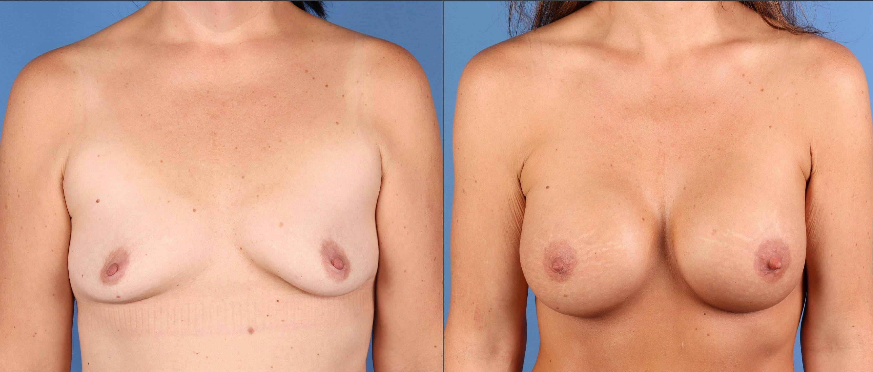 Breast Augmentation Before & After Gallery - Patient 188613 - Image 1