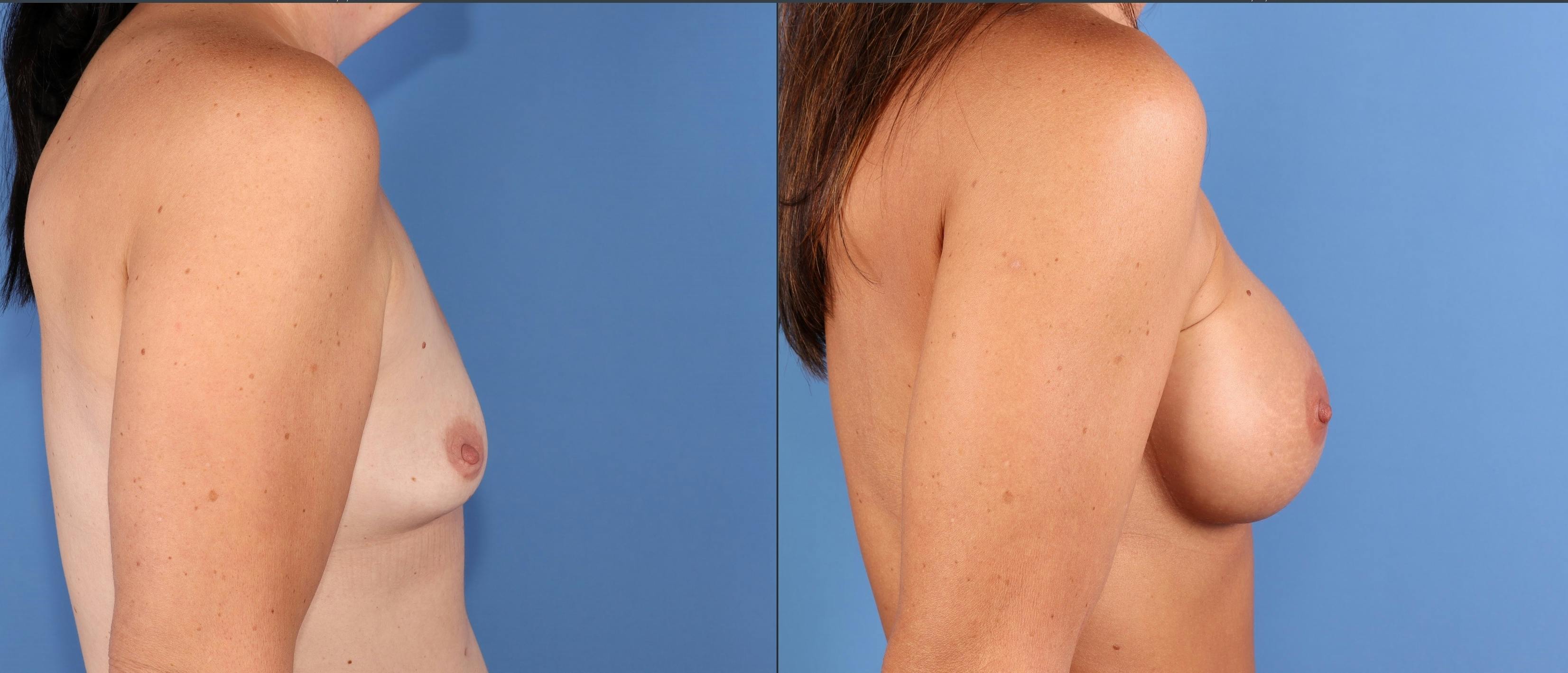 Breast Augmentation Before & After Gallery - Patient 188613 - Image 3