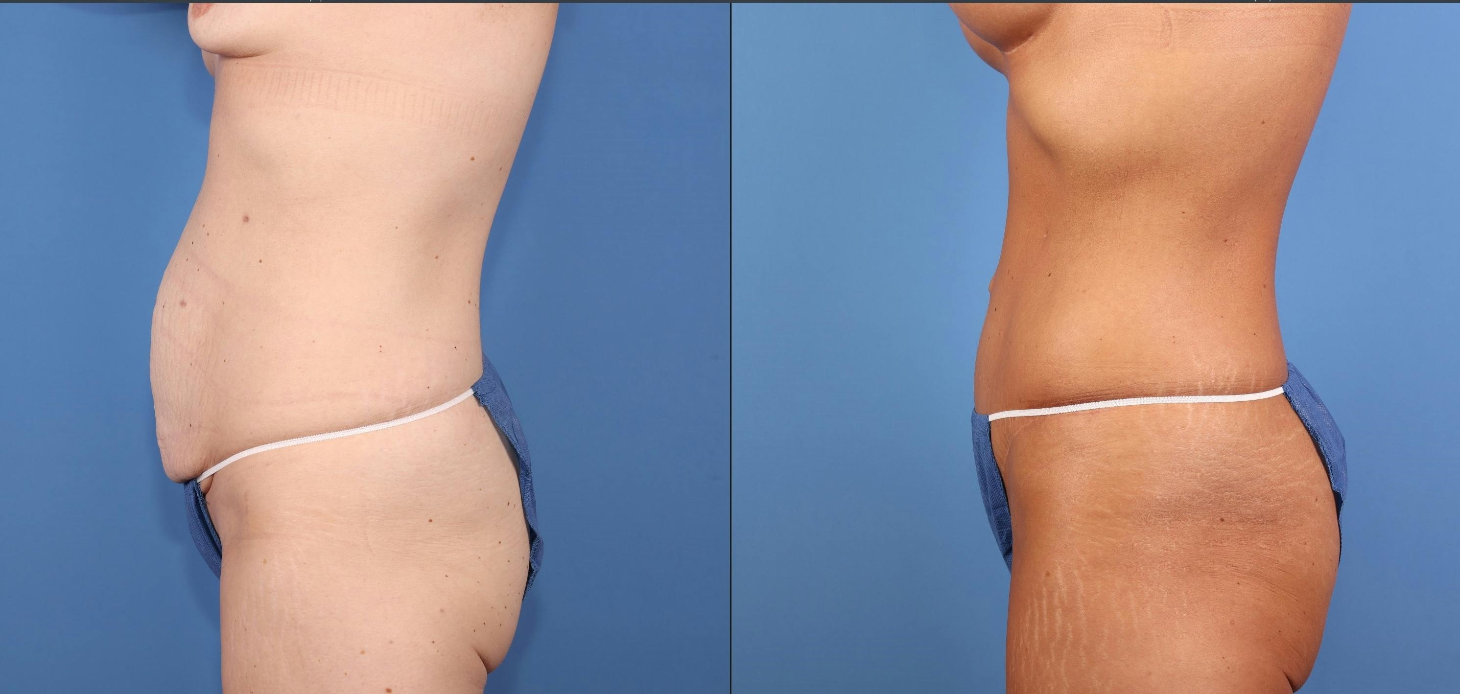 Tummy Tuck Before & After Gallery - Patient 211416 - Image 3