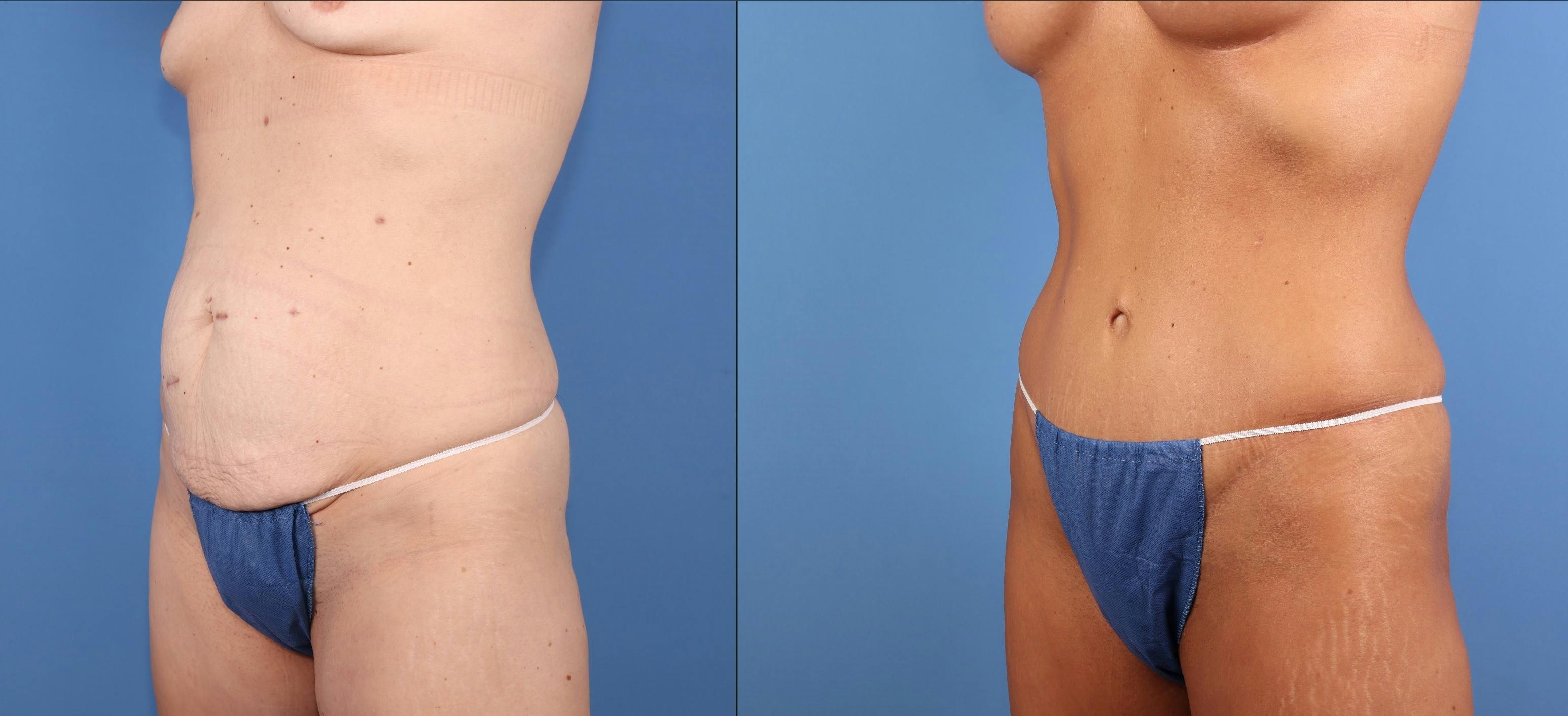 Tummy Tuck Before & After Gallery - Patient 211416 - Image 2