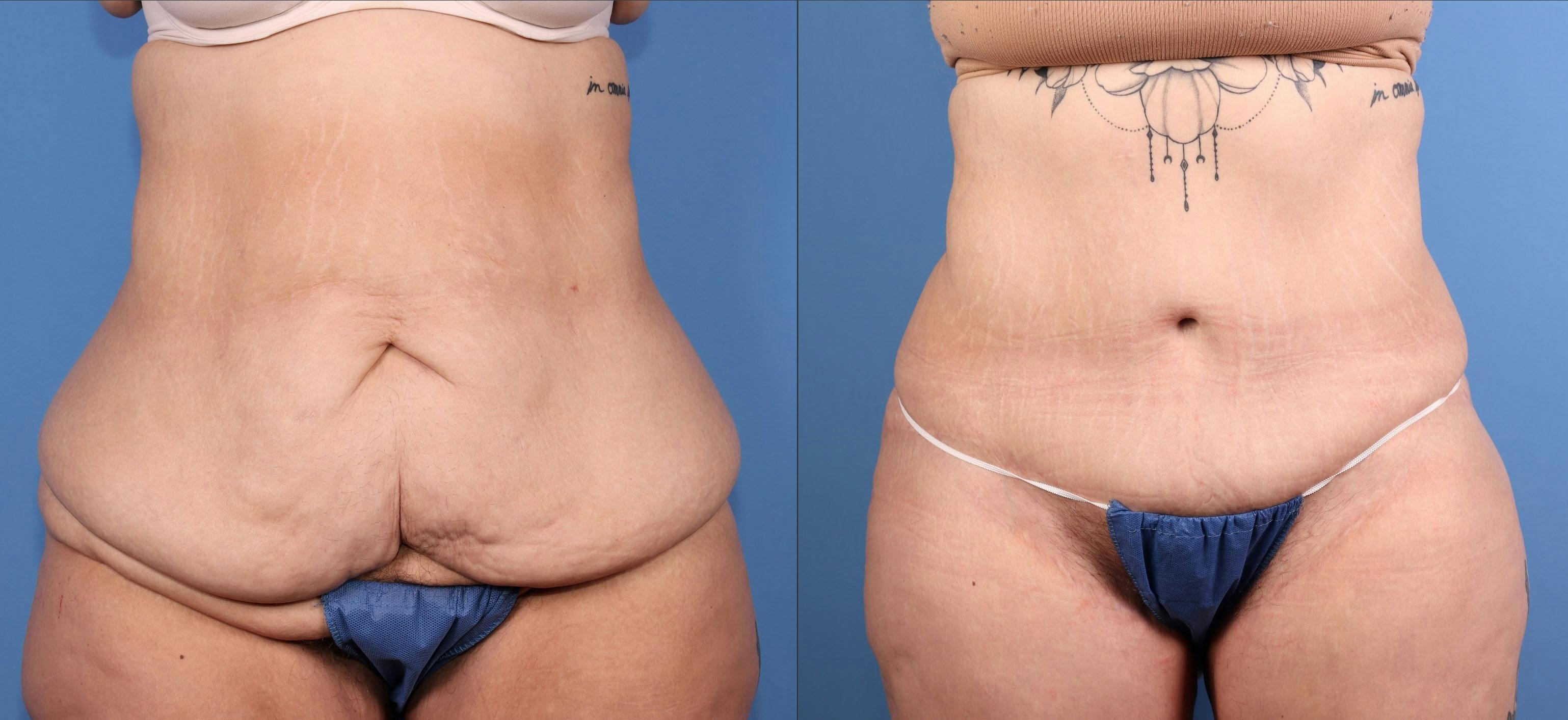 Tummy Tuck Before & After Gallery - Patient 318248 - Image 1