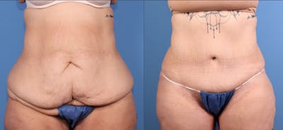 Tummy Tuck Before & After Gallery - Patient 318248 - Image 1