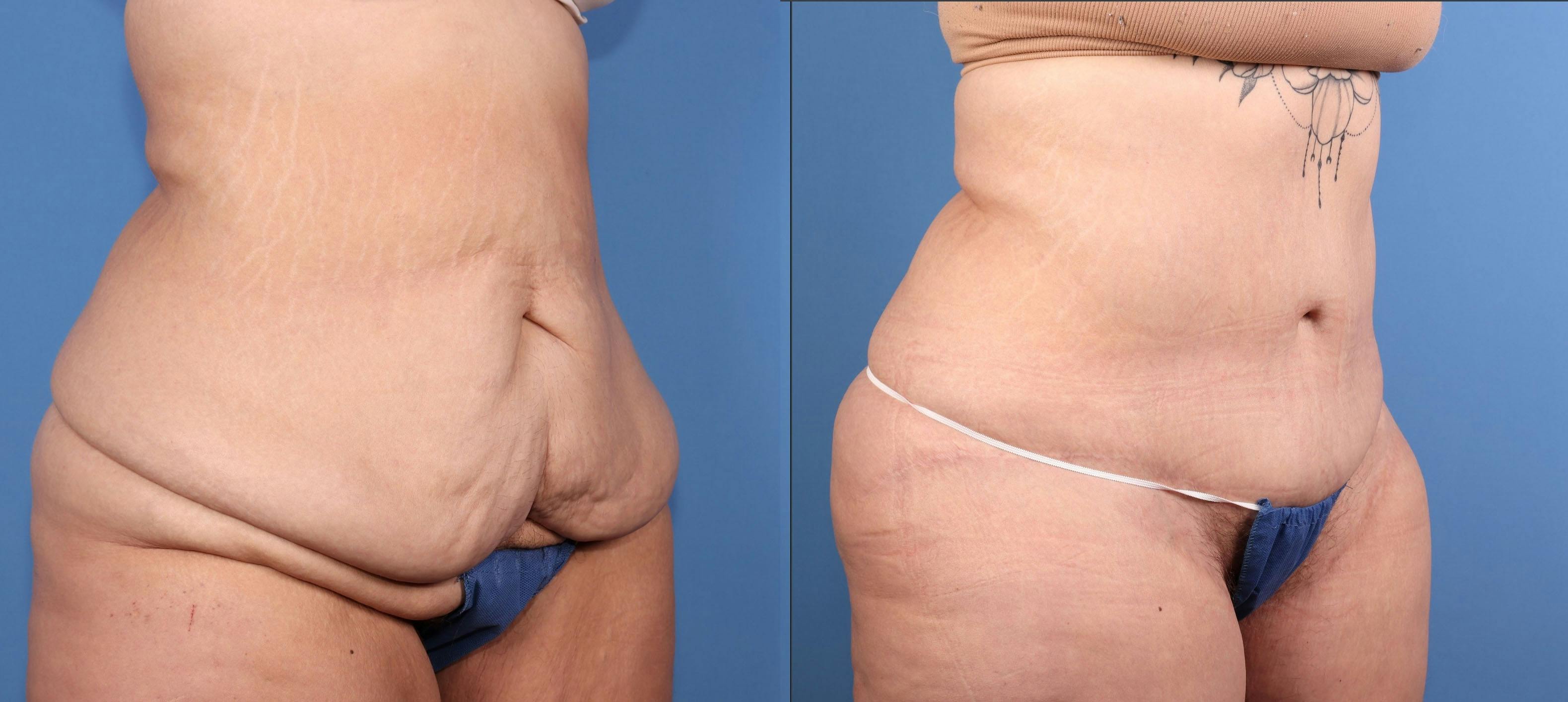 Tummy Tuck Before & After Gallery - Patient 318248 - Image 2