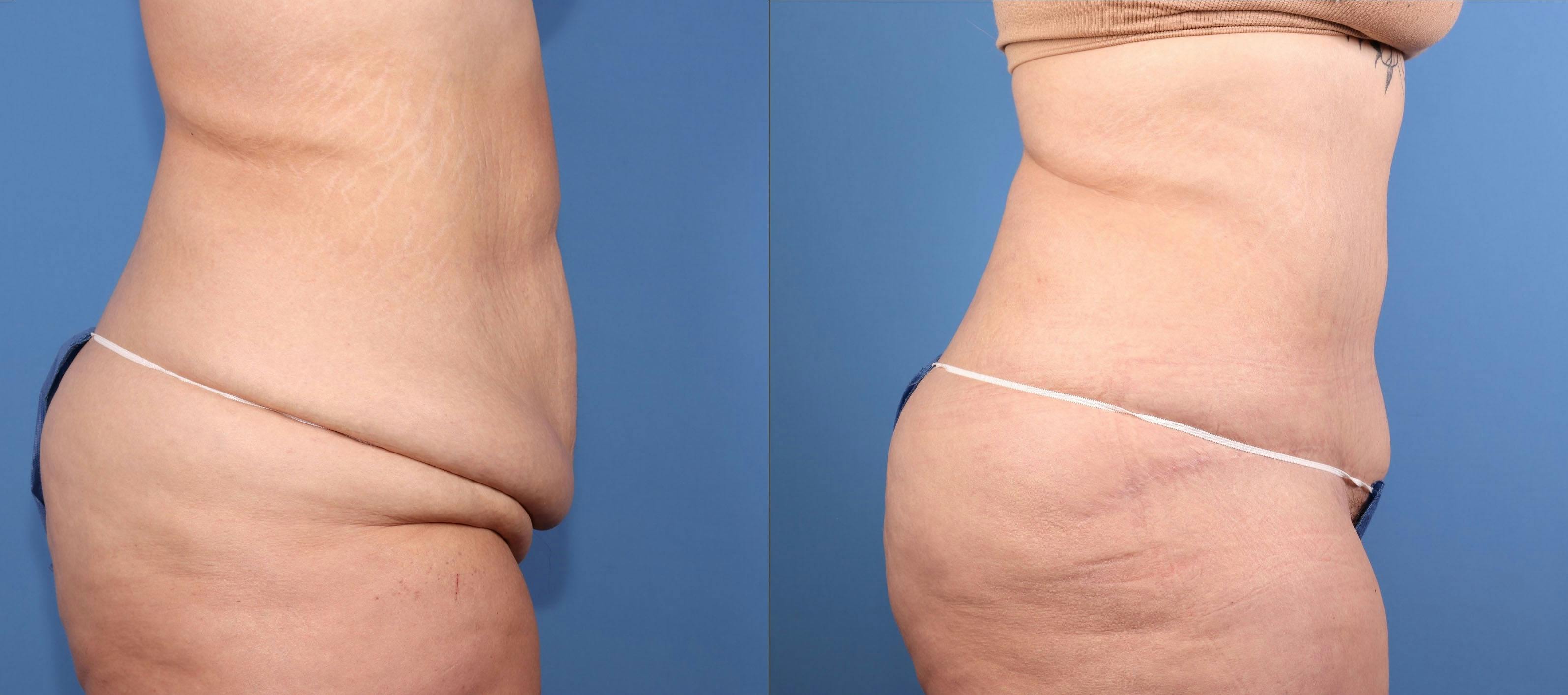 Tummy Tuck Before & After Gallery - Patient 318248 - Image 3