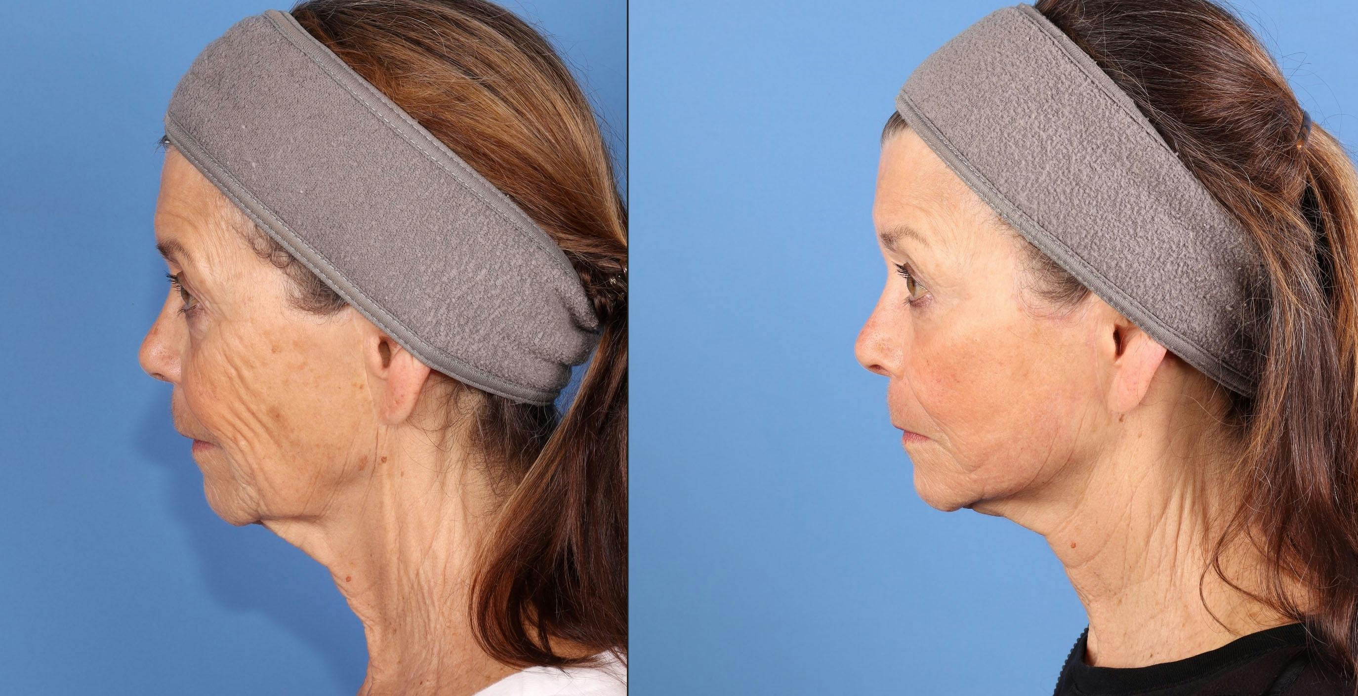 Contour TRL Laser Before & After Gallery - Patient 272041 - Image 4