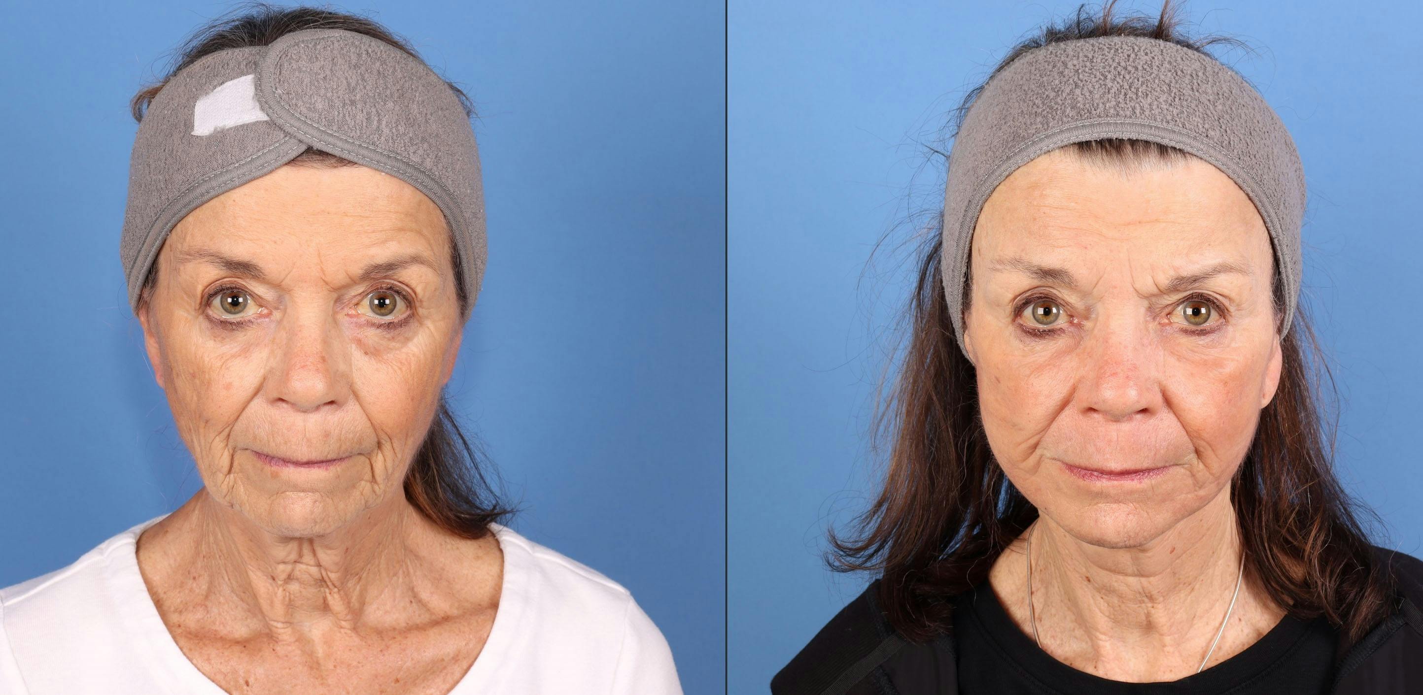Contour TRL Laser Before & After Gallery - Patient 272041 - Image 1