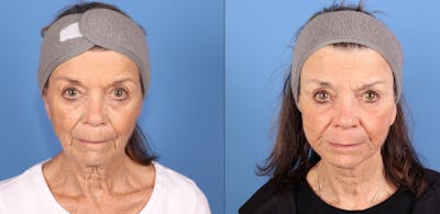 Contour TRL Laser Before & After Gallery - Patient 272041 - Image 1