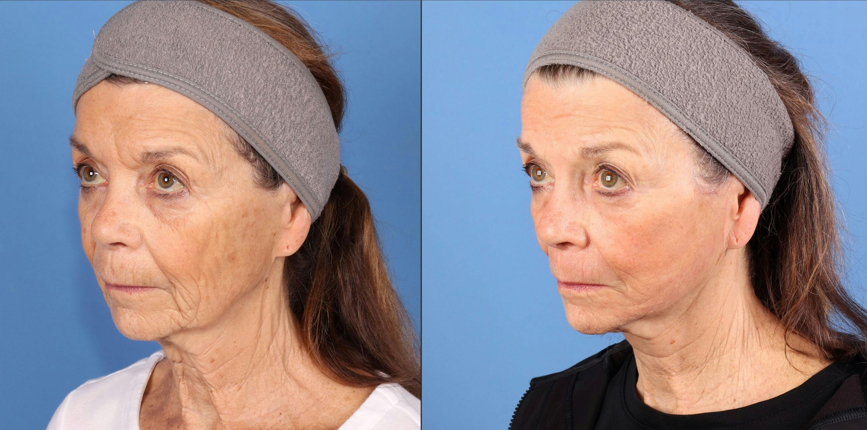 Contour TRL Laser Before & After Gallery - Patient 272041 - Image 3