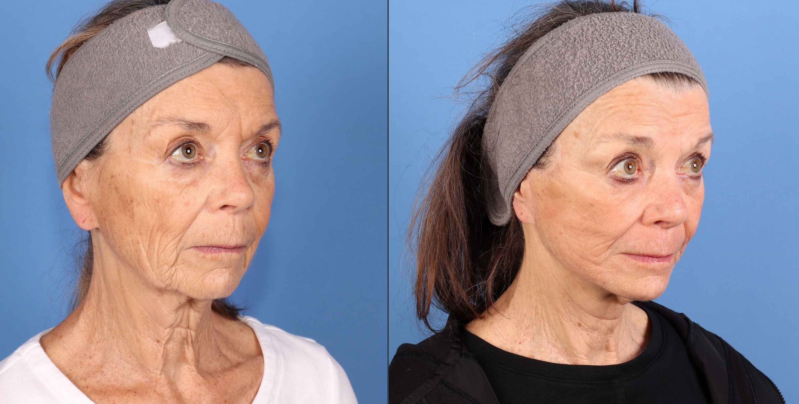 Patient 314993 | Face Lift Before & After Photos | Dr. Guy Cappuccino