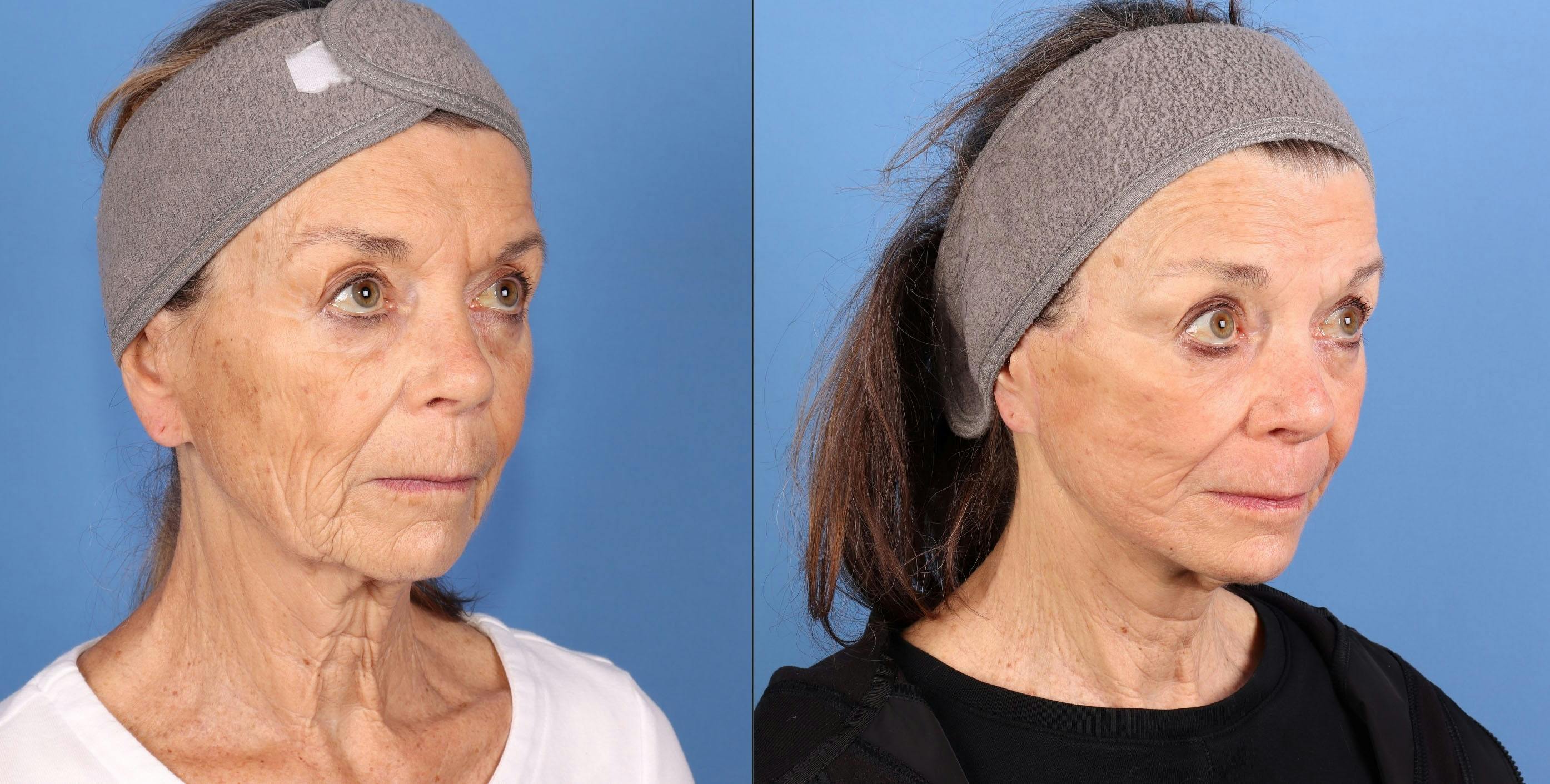 Contour TRL Laser Before & After Gallery - Patient 272041 - Image 2