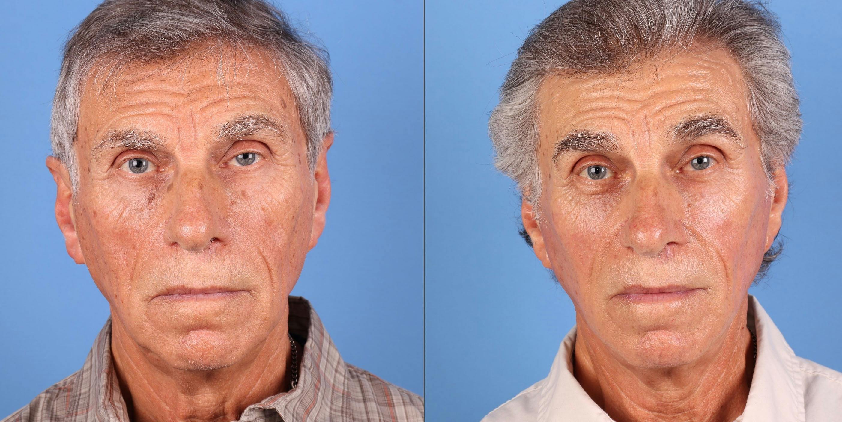 Face Lift Before & After Gallery - Patient 654667 - Image 1