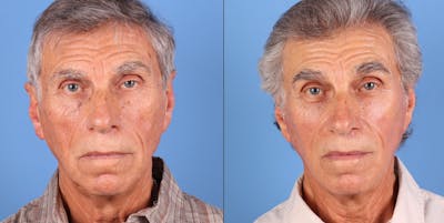 Face Lift Before & After Gallery - Patient 654667 - Image 1