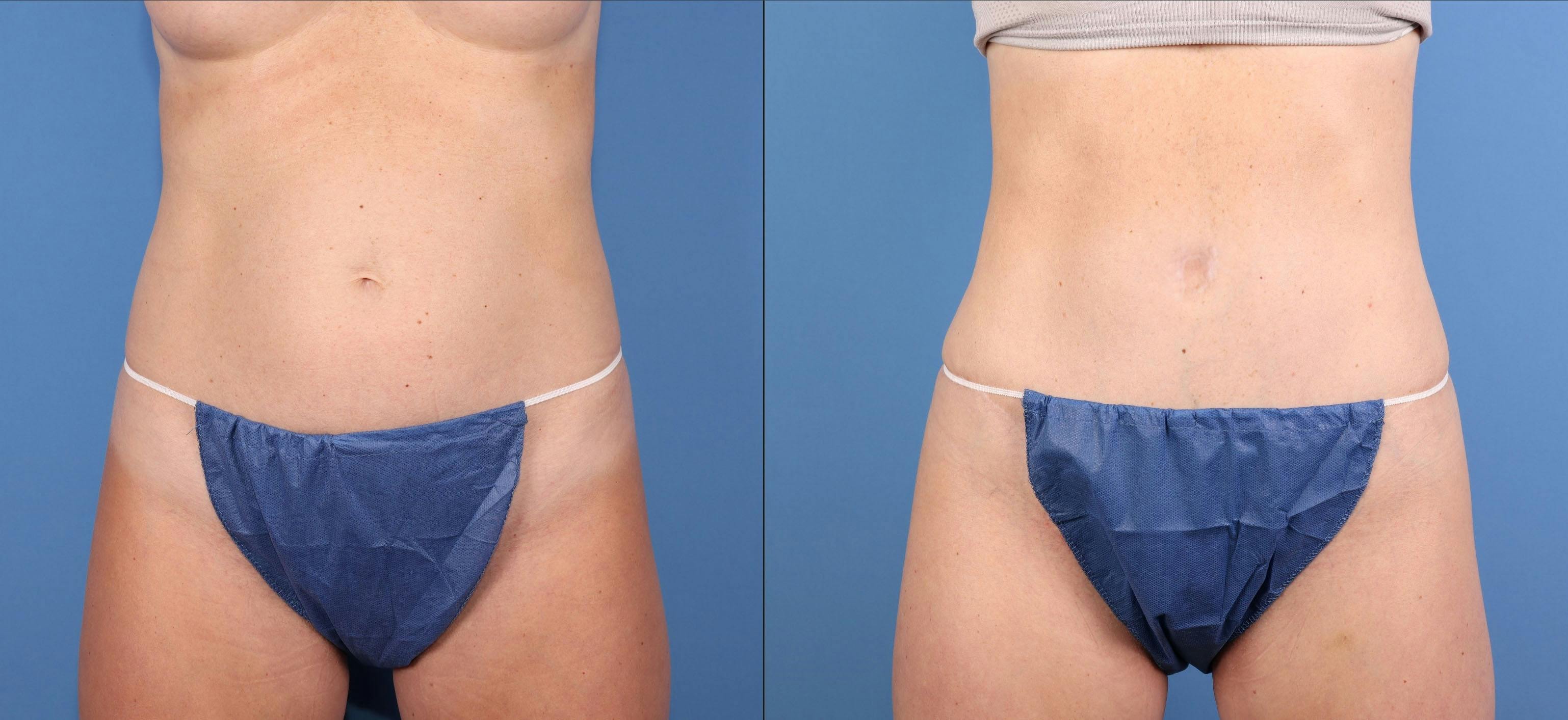 Tummy Tuck Before & After Gallery - Patient 818253 - Image 1