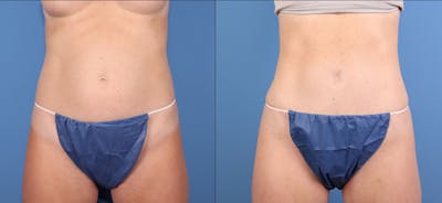 Tummy Tuck Before & After Gallery - Patient 818253 - Image 1