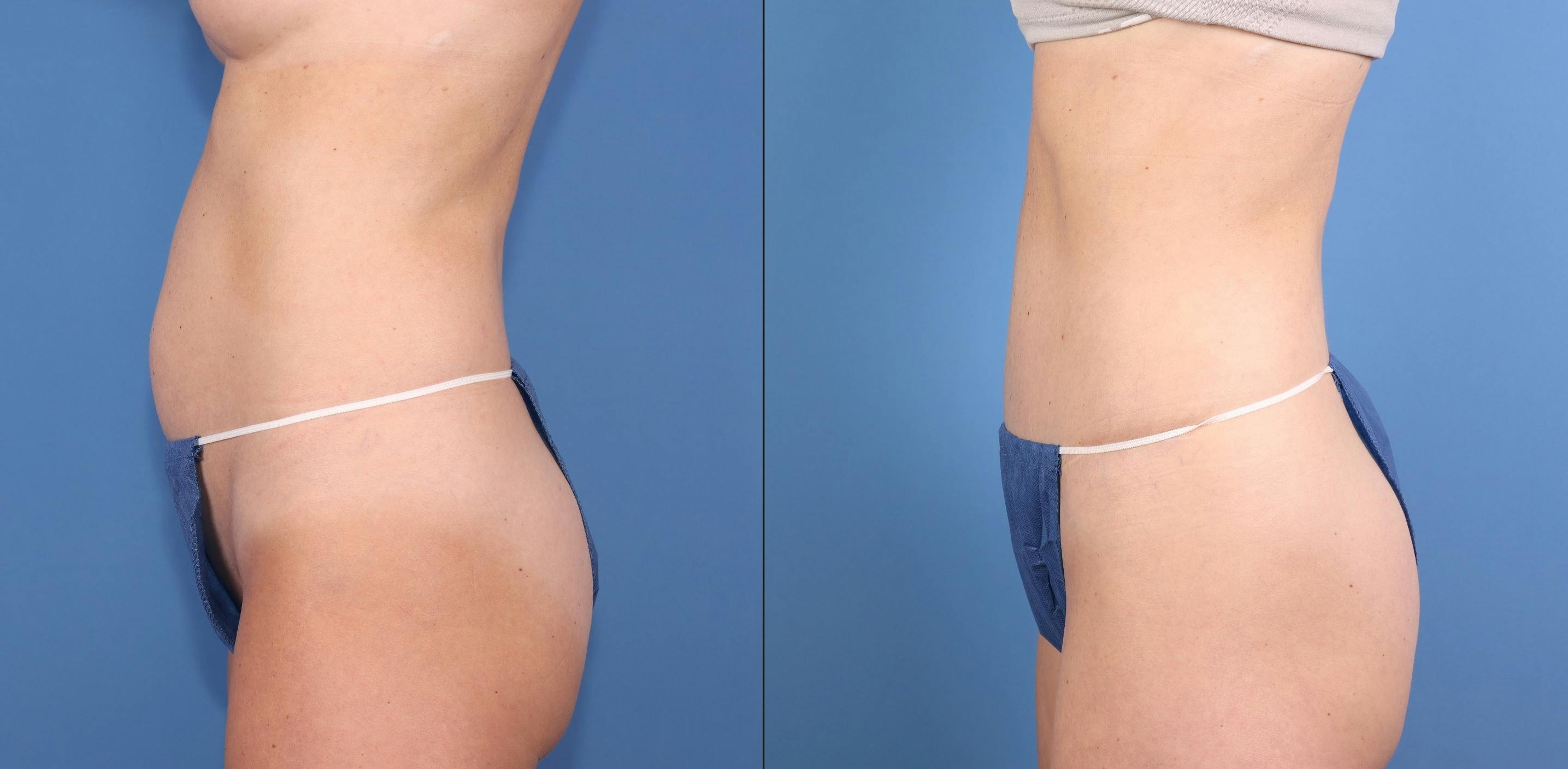 Tummy Tuck Before & After Gallery - Patient 818253 - Image 3