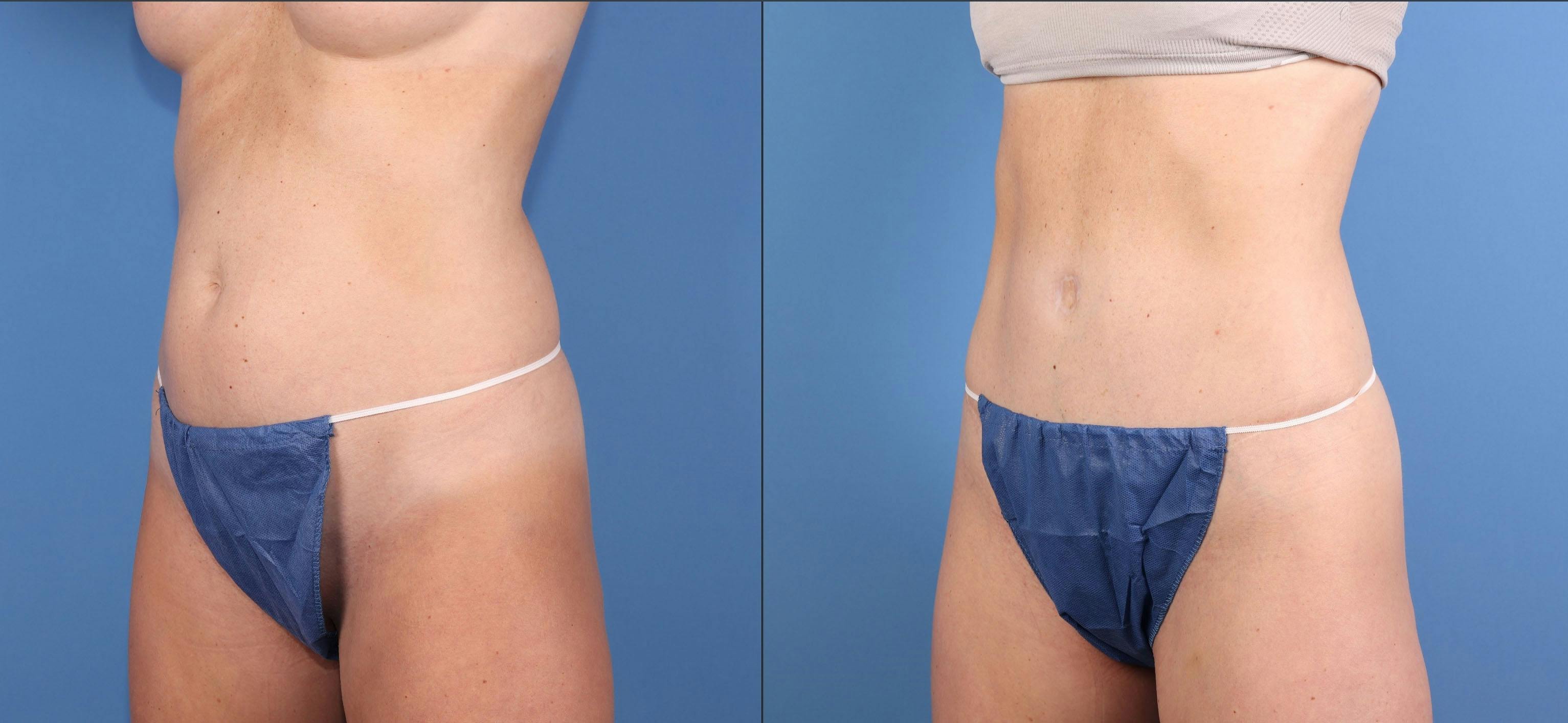 Tummy Tuck Before & After Gallery - Patient 818253 - Image 2