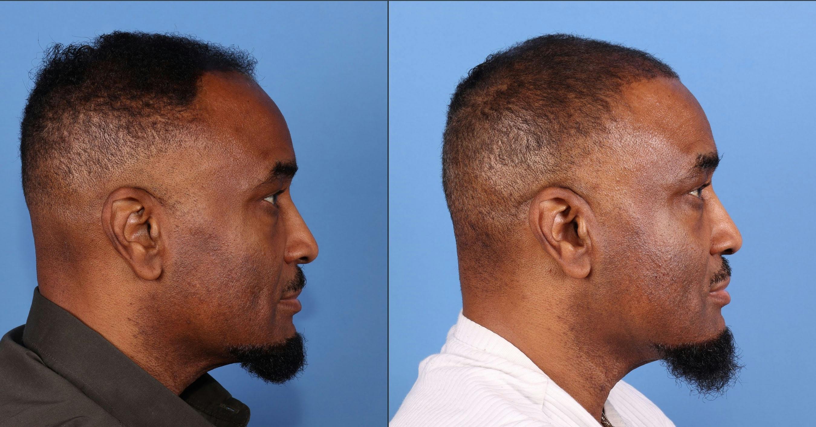 NeoGraft Hair Restoration Before & After Gallery - Patient 197365 - Image 4