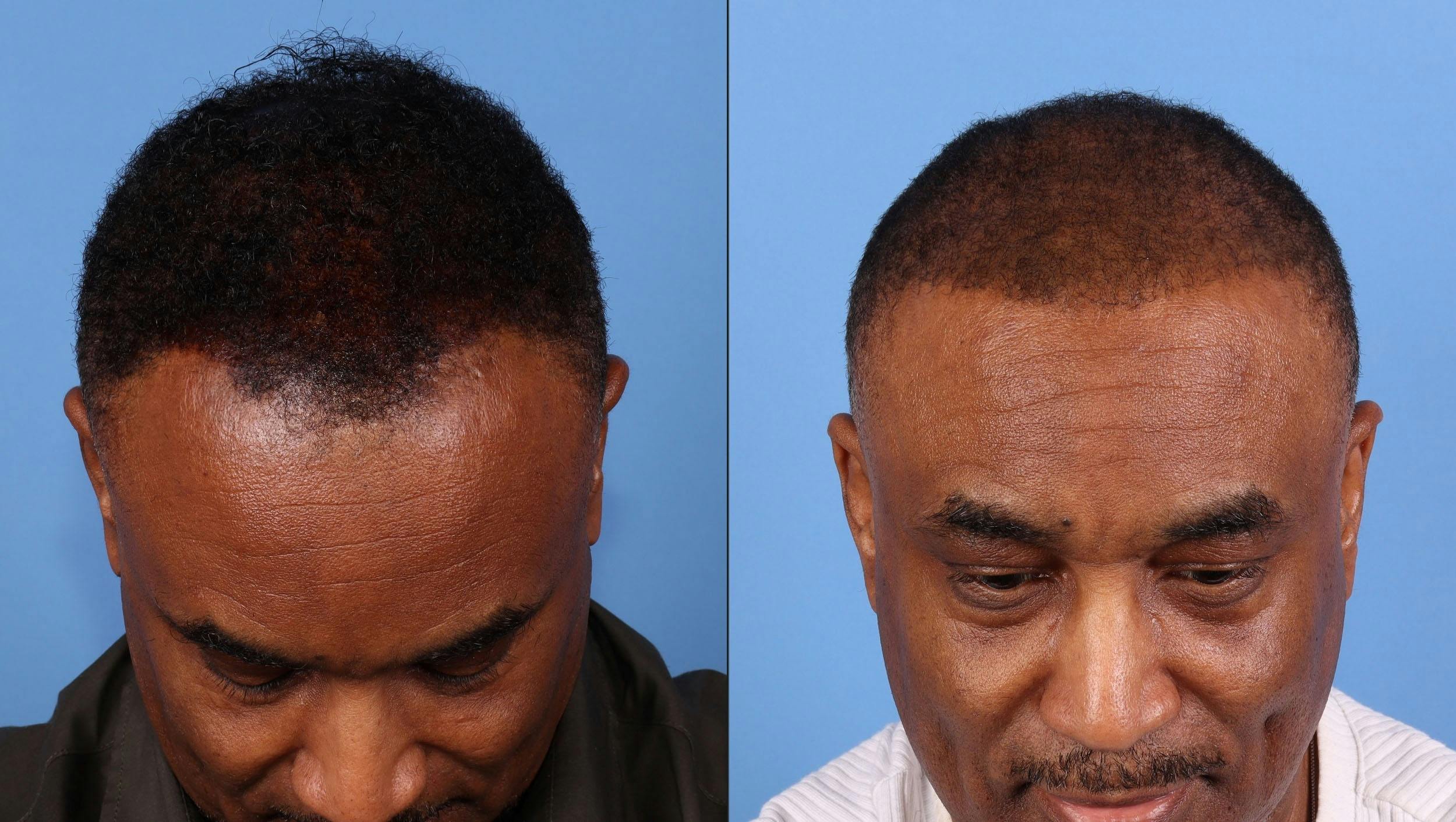 NeoGraft Hair Restoration Before & After Gallery - Patient 197365 - Image 2