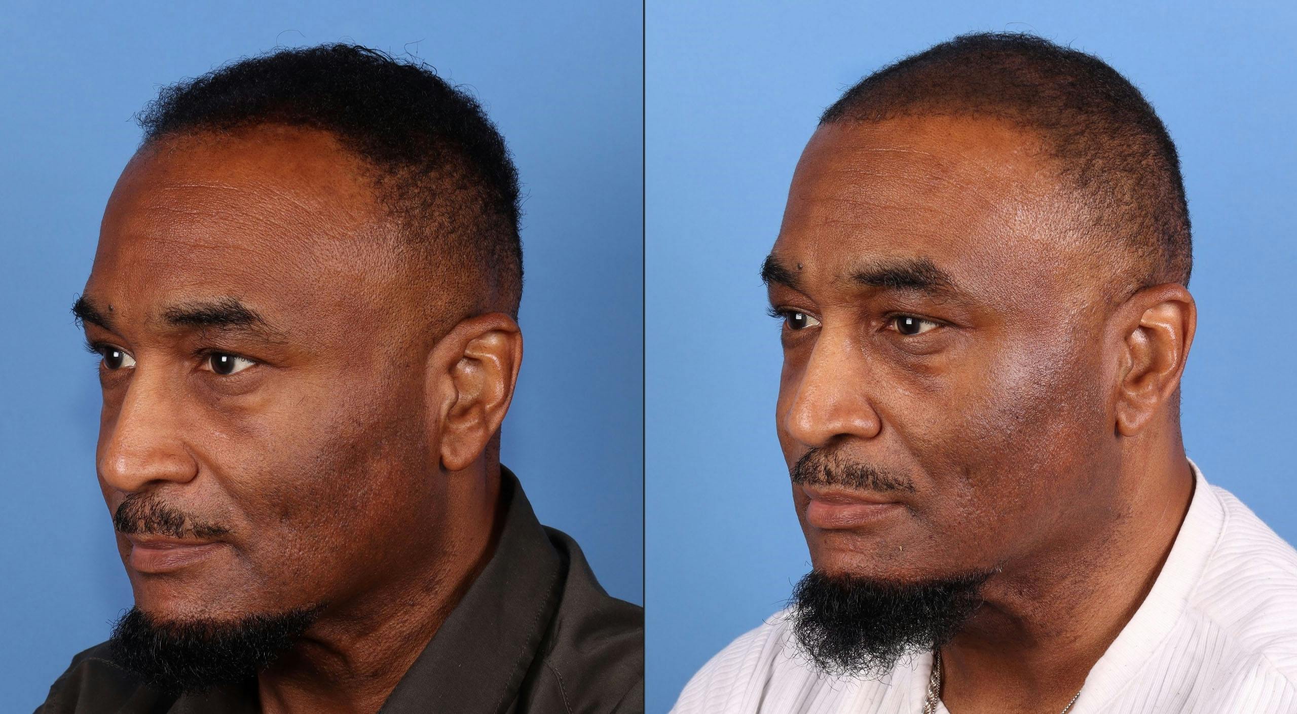 NeoGraft Hair Restoration Before & After Gallery - Patient 197365 - Image 6