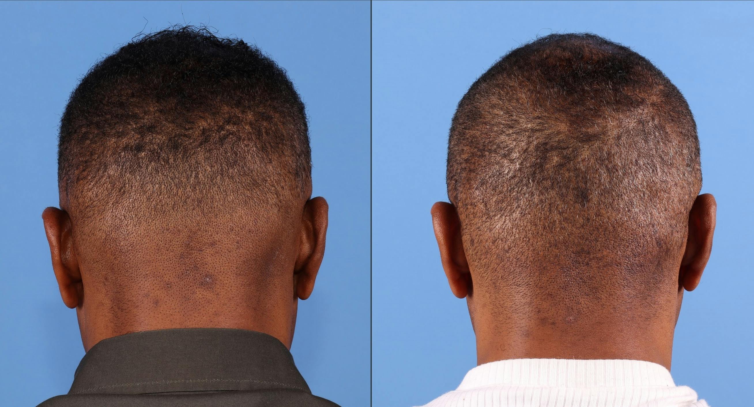 NeoGraft Hair Restoration Before & After Gallery - Patient 197365 - Image 5