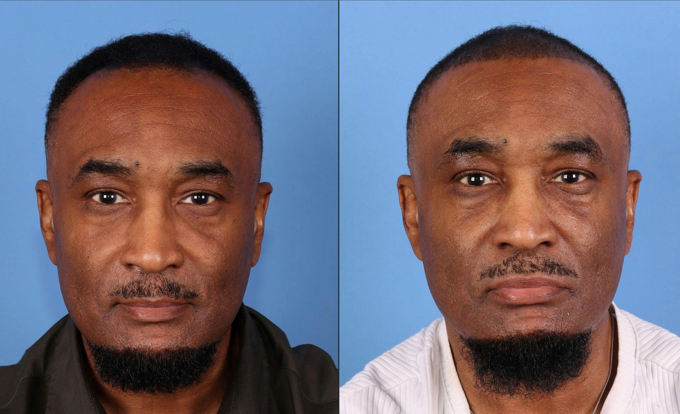 NeoGraft Hair Restoration Before & After Gallery - Patient 197365 - Image 1