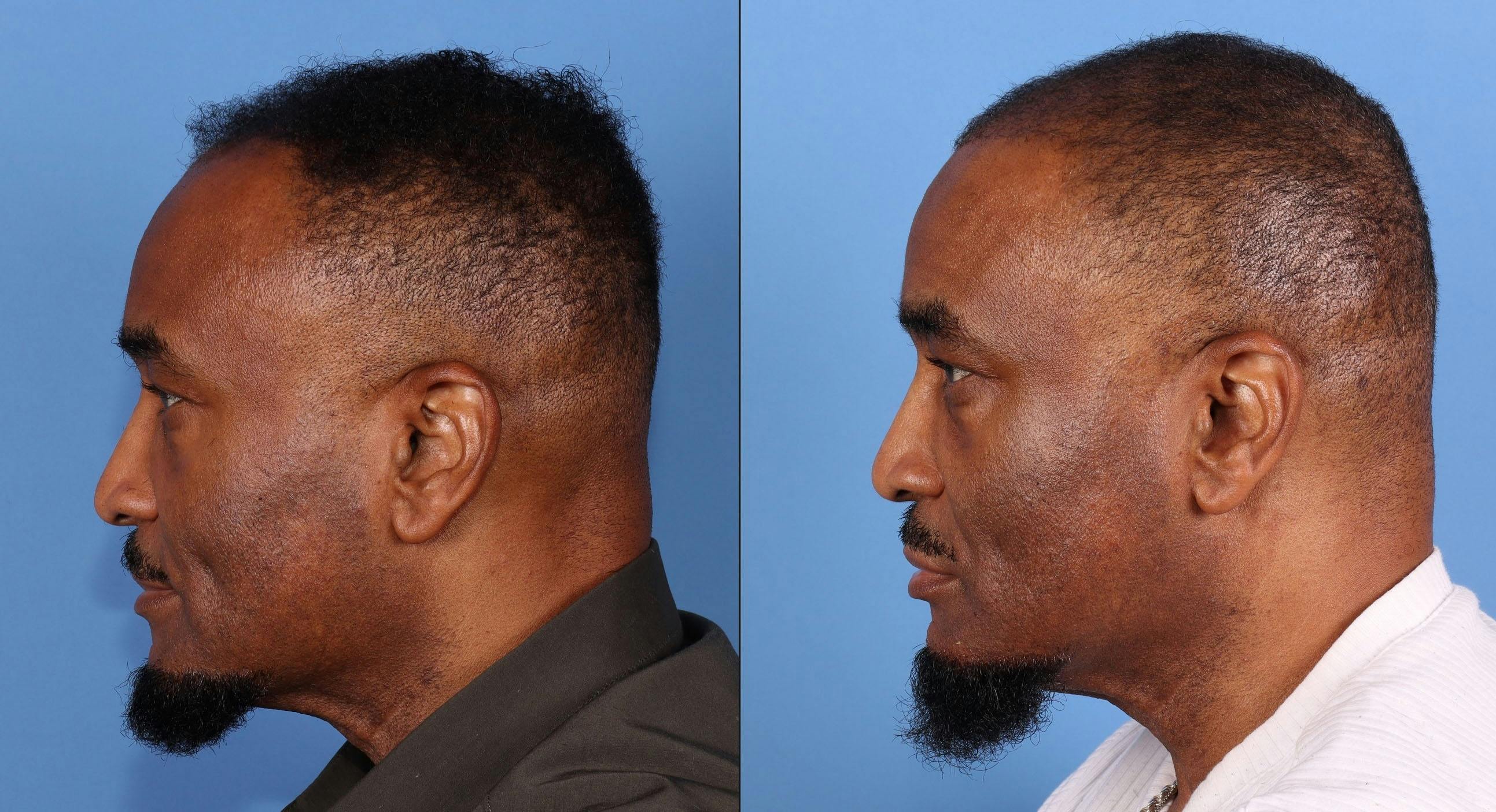 NeoGraft Hair Restoration Before & After Gallery - Patient 197365 - Image 7