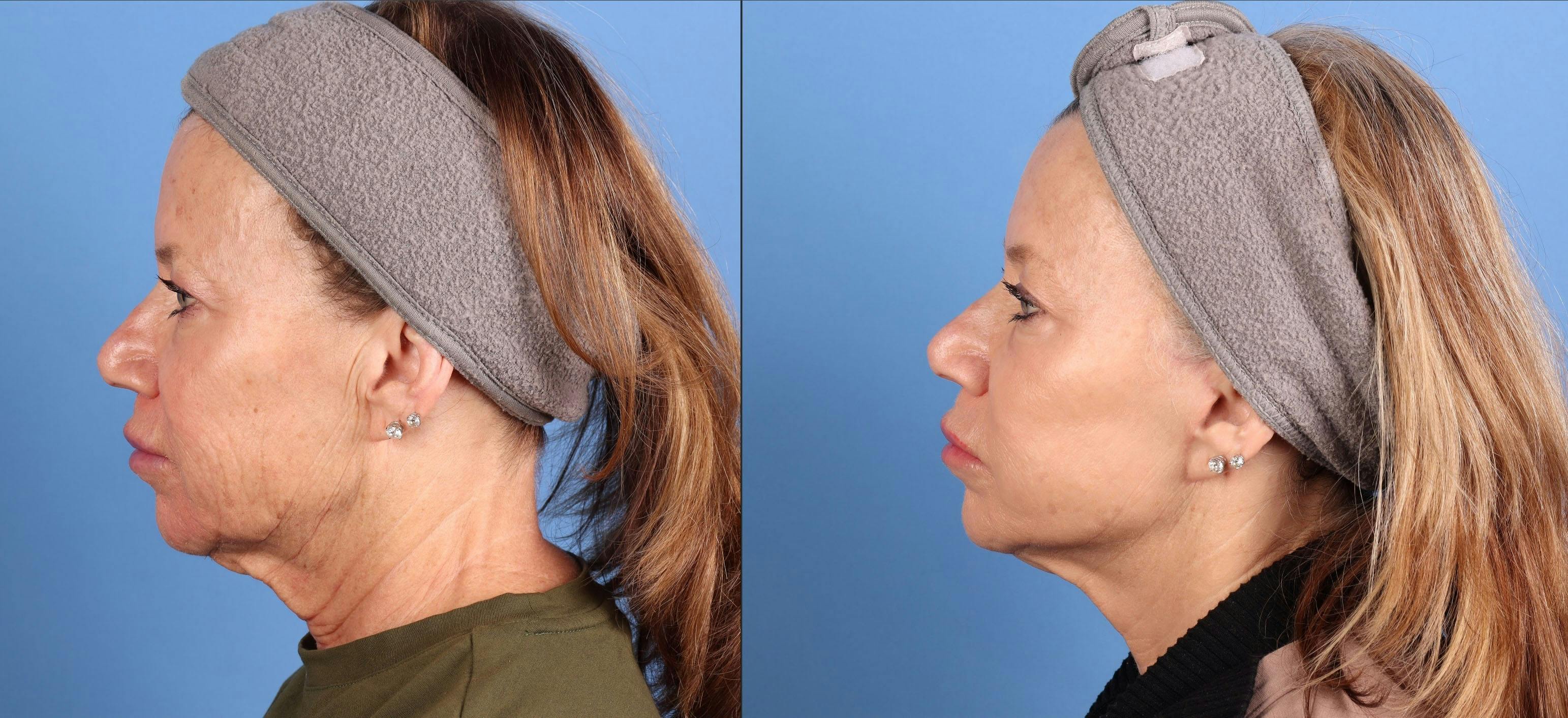 BBL Laser Before & After Gallery - Patient 281555 - Image 5