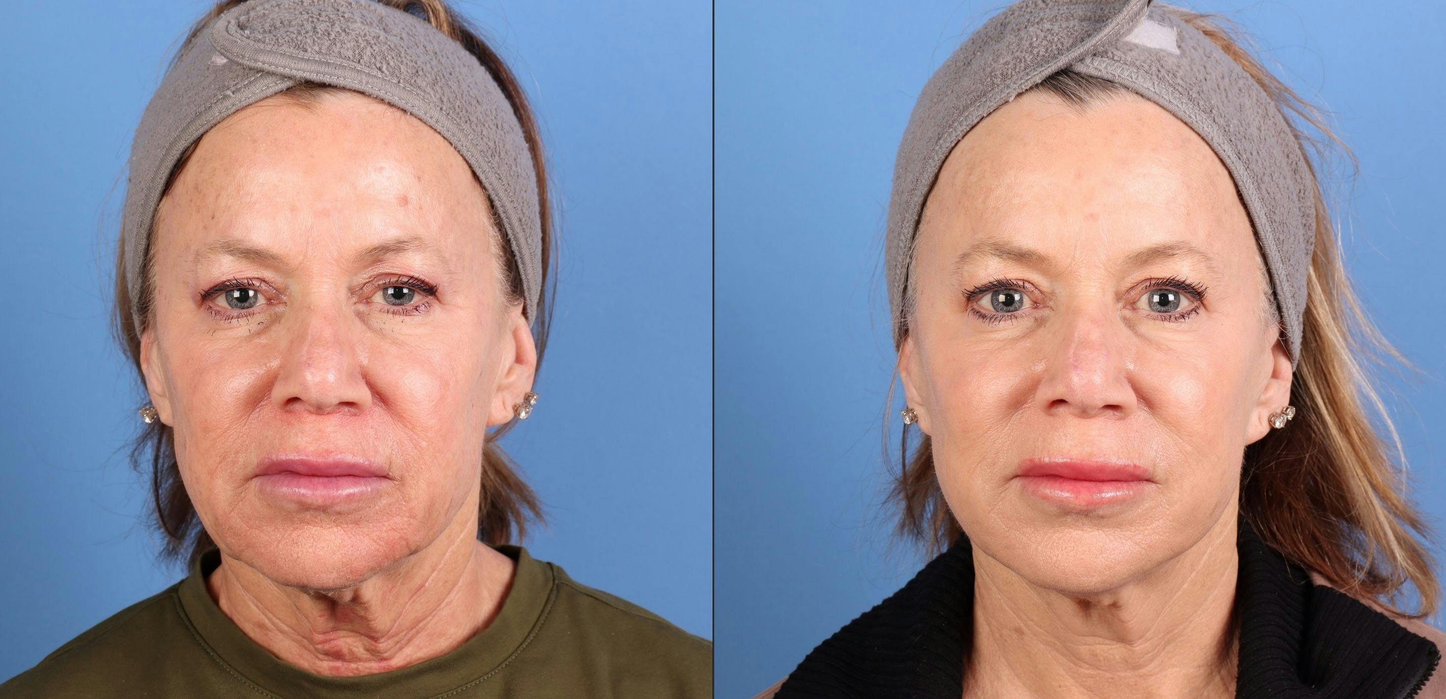 BBL Laser Before & After Gallery - Patient 281555 - Image 1