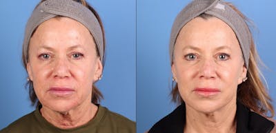 Face Lift Before & After Gallery - Patient 383346 - Image 1