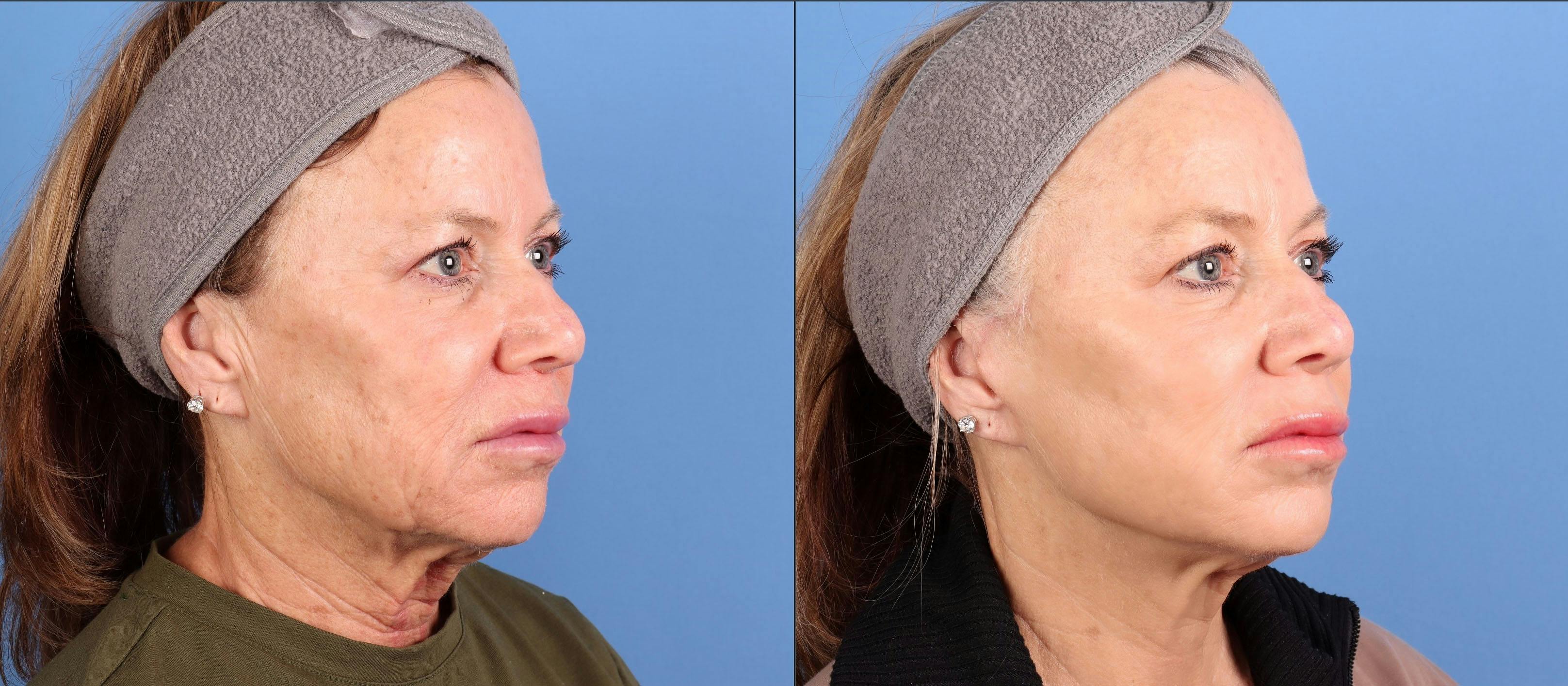 BBL Laser Before & After Gallery - Patient 281555 - Image 2