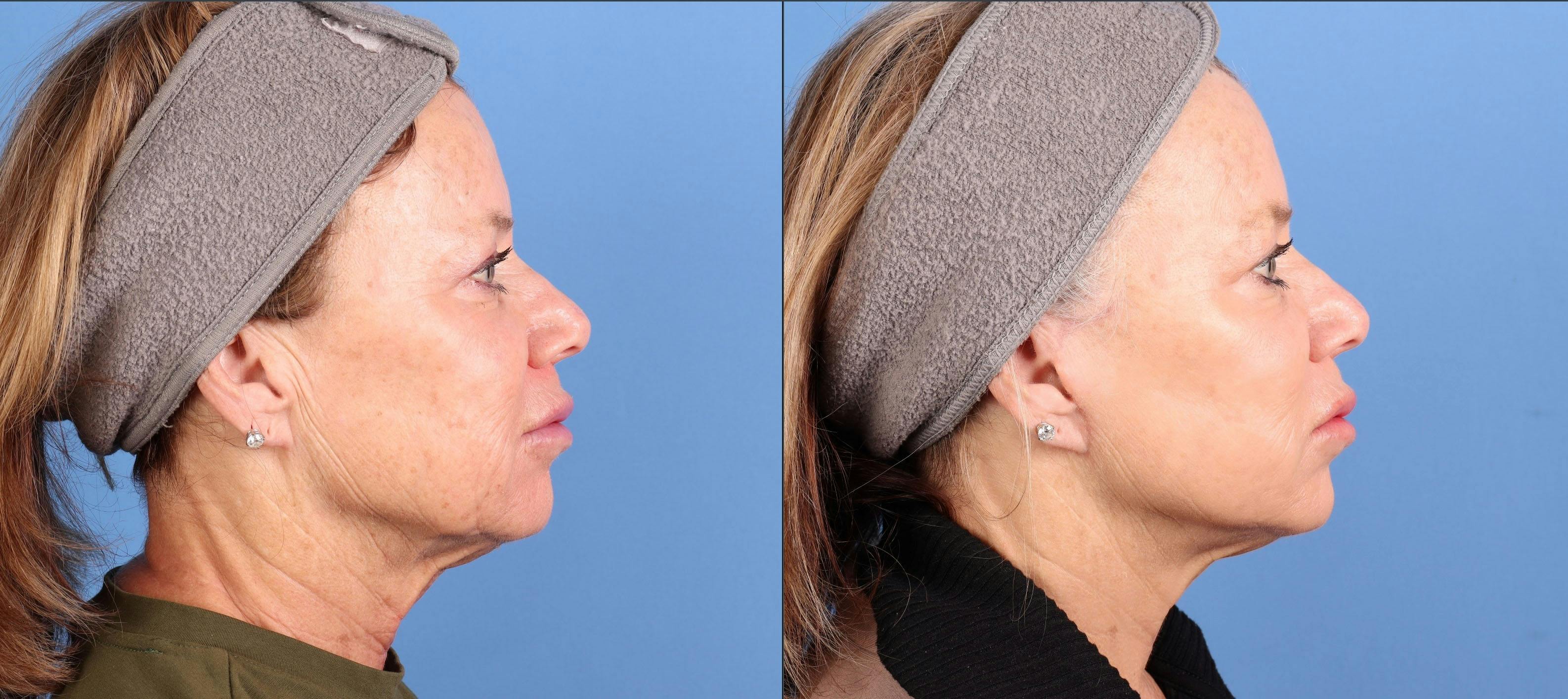 BBL Laser Before & After Gallery - Patient 281555 - Image 3