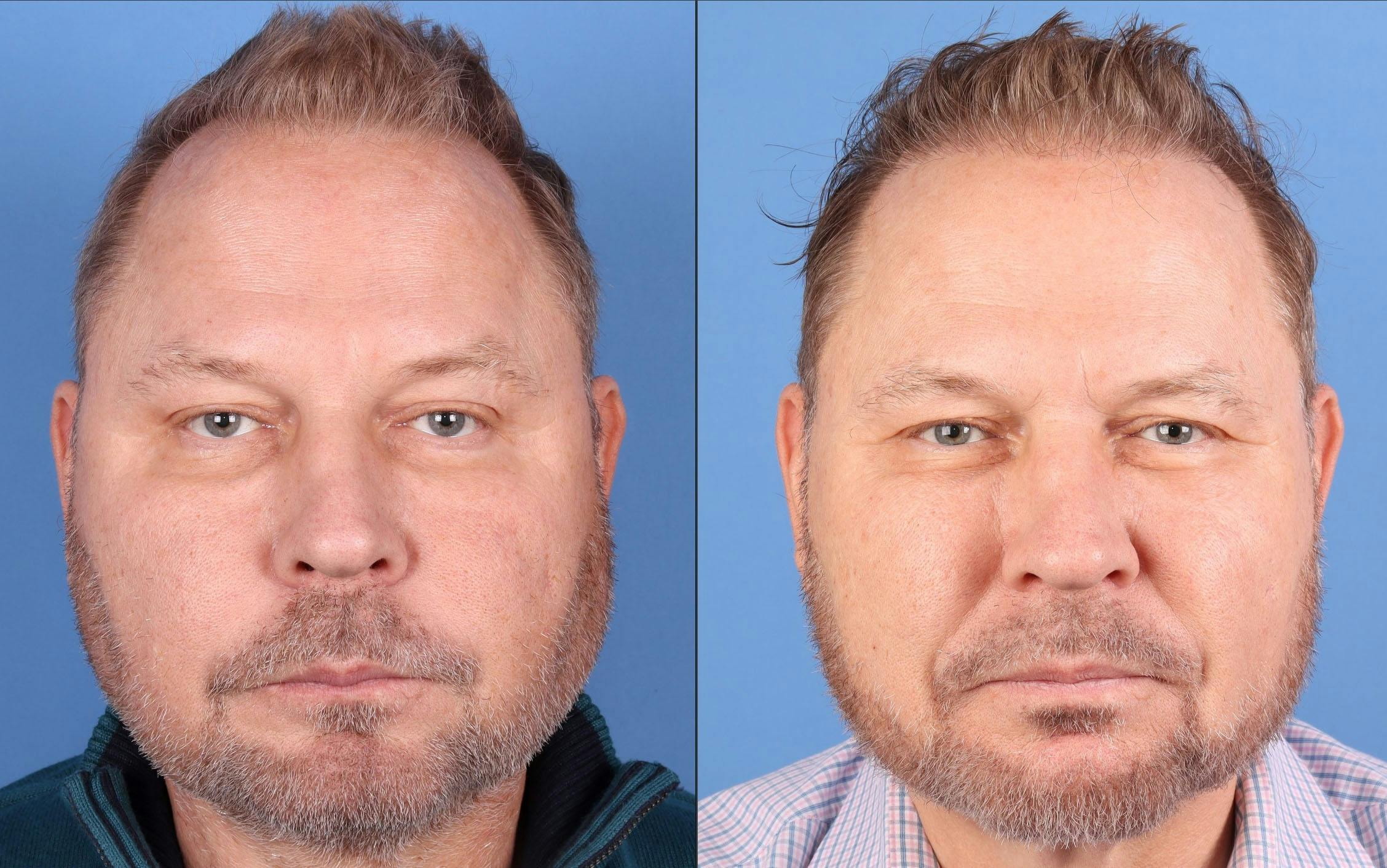 NeoGraft Hair Restoration Before & After Gallery - Patient 225541 - Image 1