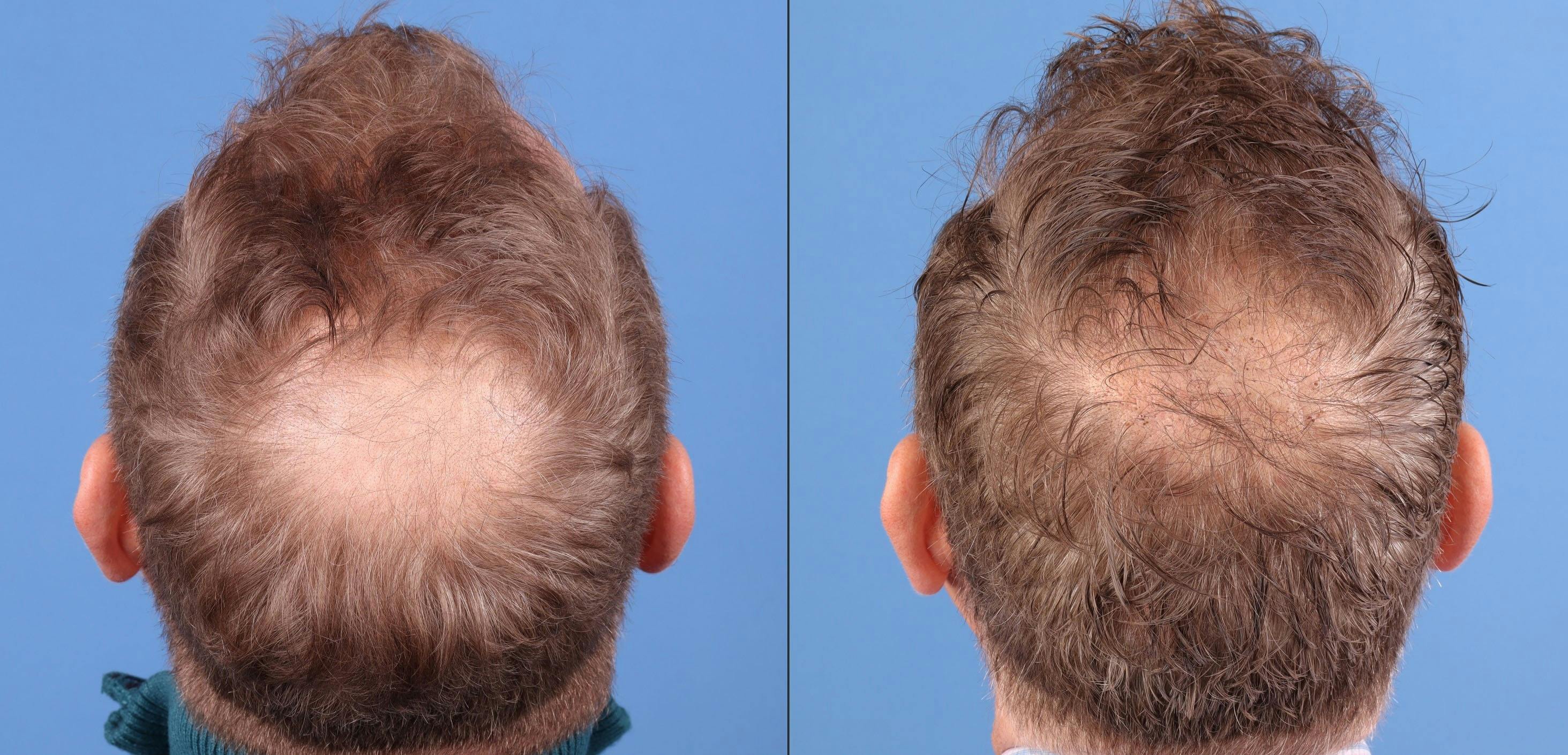 NeoGraft Hair Restoration Before & After Gallery - Patient 225541 - Image 3