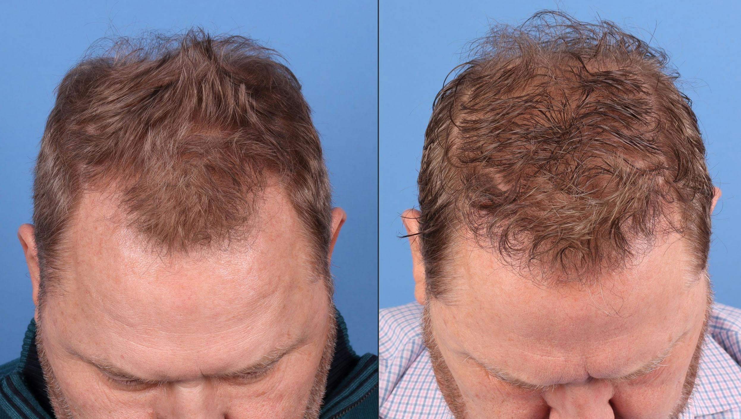 NeoGraft Hair Restoration Before & After Gallery - Patient 225541 - Image 2