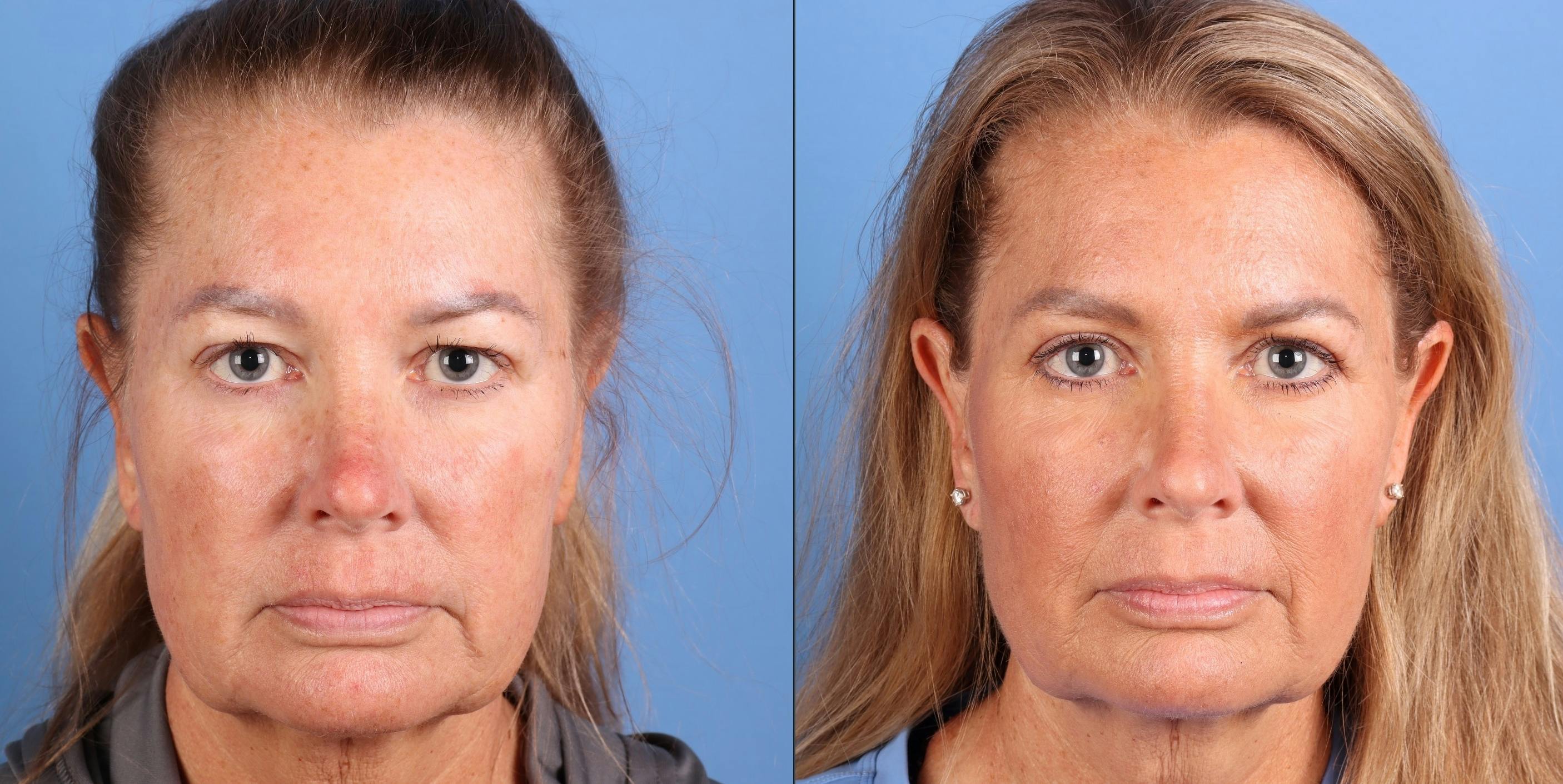 Eyelid Surgery (Upper Blepharoplasty) Before & After Gallery - Patient 395134 - Image 1