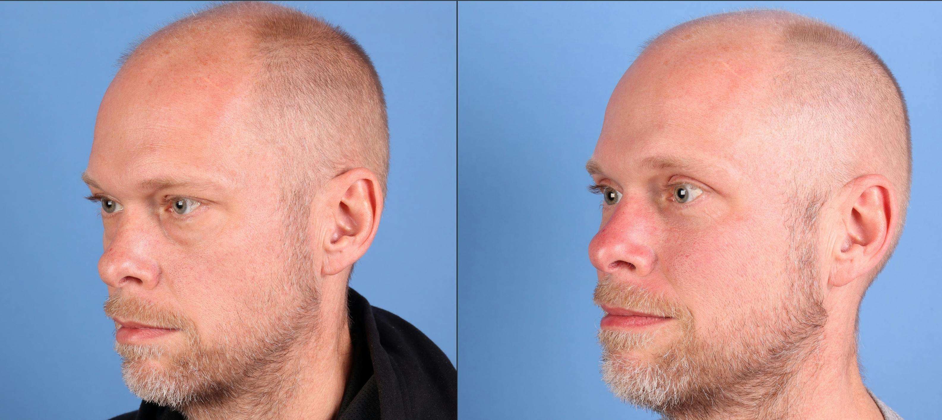 Fat Grafting Before & After Gallery - Patient 344675 - Image 3