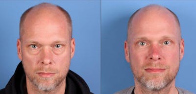Eyelid Surgery (Upper & Lower Blepharoplasty) Before & After Gallery - Patient 401070 - Image 1