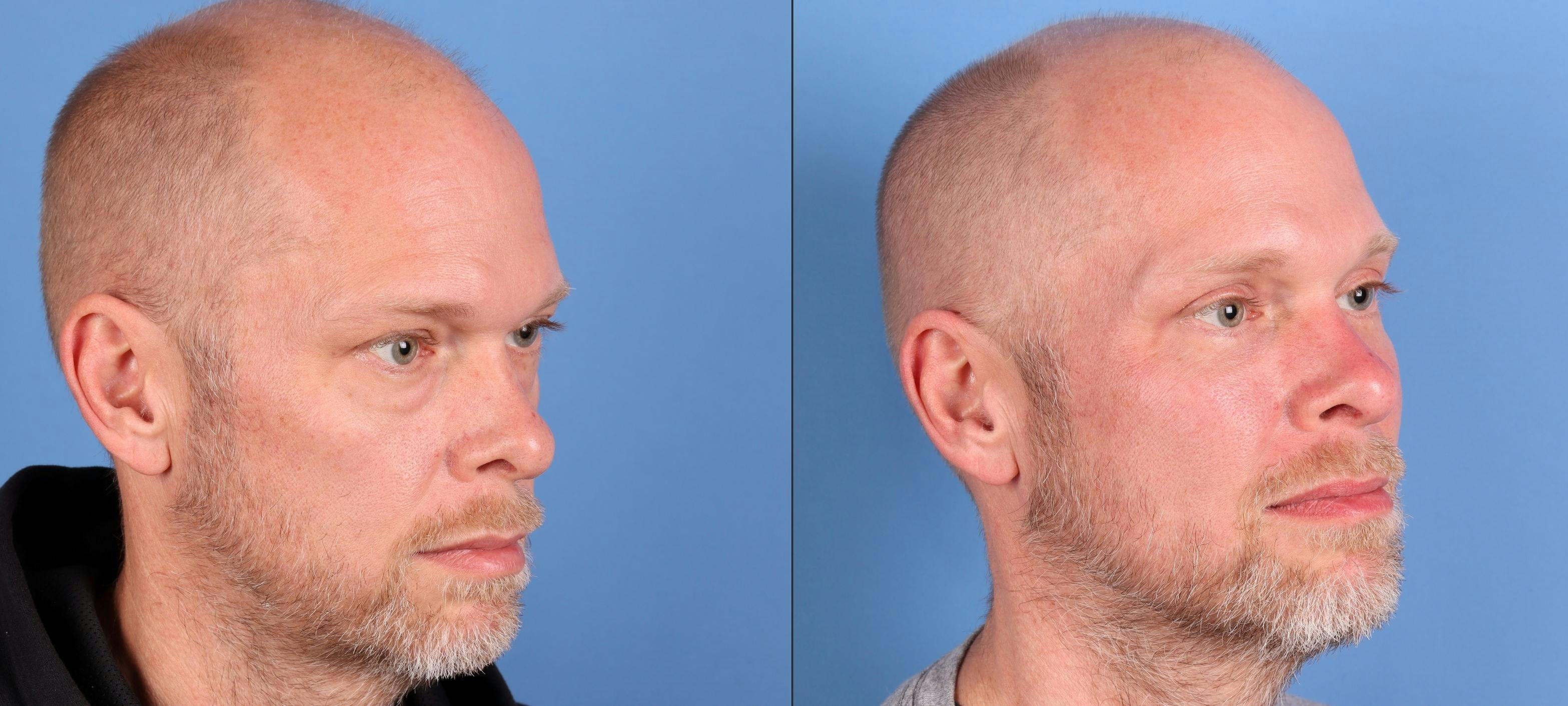 Fat Grafting Before & After Gallery - Patient 344675 - Image 2